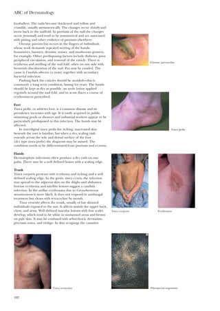 footballers. The nails become thickened and yellow and
crumble, usually asymmetrically. The changes occur distally and
move back to the nailfold. In psoriasis of the nail the changes
occur proximally and tend to be symmetrical and are associated
with pitting and other evidence of psoriasis elsewhere.
Chronic paronychia occurs in the fingers of individuals
whose work demands repeated wetting of the hands:
housewives, barmen, dentists, nurses, and mushroom growers,
for example. Other predisposing factors include diabetes, poor
peripheral circulation, and removal of the cuticle. There is
erythema and swelling of the nail fold, often on one side with
brownish discoloration of the nail. Pus may be exuded. The
cause is Candida albicans (a yeast) together with secondary
bacterial infection.
Pushing back the cuticles should be avoided—this is
commonly a long term condition, lasting for years. The hands
should be kept as dry as possible, an azole lotion applied
regularly around the nail fold, and in acute flares a course of
erythromycin prescribed.
Feet
Tinea pedis, or athletes foot, is a common disease and its
prevalence increases with age. It is easily acquired in public
swimming pools or showers and industrial workers appear to be
particularly predisposed to this infection. The hands may be
affected.
In interdigital tinea pedis the itching, macerated skin
beneath the toes is familiar, but when a dry, scaling rash
extends across the sole and dorsal surface of the foot
(dry type tinea pedis) the diagnosis may be missed. The
condition needs to be differentiated from psoriasis and eczema.
Hands
Dermatophyte infections often produce a dry rash on one
palm. There may be a well defined lesion with a scaling edge.
Trunk
Tinea corporis presents with erythema and itching and a well
defined scaling edge. In the groin, tinea cruris, the infection
may spread to the adjacent skin on the thighs and abdomen.
Intense erythema and satellite lesions suggest a candida
infection. In the axillae erythrasma due to Corynebacterium
minutissimum is more likely. It does not respond to antifungal
treatment but clears with tetracycline by mouth.
Tinea versicolor affects the trunk, usually of fair skinned
individuals exposed to the sun. It affects mainly the upper back,
chest, and arms. Well defined macular lesions with fine scales
develop, which tend to be white in suntanned areas and brown
on pale skin. It may be confused with seborrhoeic dermatitis,
pityriasis rosea, and vitiligo. In skin scrapings the causative
ABC of Dermatology
102
Chronic paronychia
Tinea pedis
Tinea corporis Erythrasma
Tinea versicolor Pityrosporum organisms
 