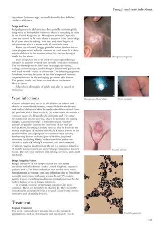 organisms, Malassezia spp., normally found in hair follicles,
can be readily seen.
Scalp and face
Scalp ringworm in children may be caused by anthropophilic
fungi such as Trichophyton tonsurans, which is spreading in cities
in the United Kingdom, or Microsporum audouinii. Sporadic
cases are caused by M.canis which is acquired from cats or dogs.
In all cases there is itching, hair loss, and some degree of
inflammation which is worse with M. canis infections.
Kerion, an inflamed, boggy, pustular lesion, is often due to
cattle ringworm and is fairly common in rural areas. It is often
seen in children in the autumn when the cows are brought
inside for the winter.
Tinea incognito is the term used for unrecognised fungal
infection in patients treated with steroids (topical or systemic).
The normal response to infection (leading to erythema,
scaling, a raised margin, and itching) is diminished, particularly
with local steroid creams or ointments. The infecting organism
flourishes, however, because of the host’s impaired immune
response—shown by the enlarging, persistent skin lesions.
The groins, hands, and face are sites where this is most
likely to occur.
Seborrhoeic dermatitis of adults may also be caused by
Malassezia.
Yeast infections
Candida infection may occur in the flexures of infants and
elderly or immobilised patients, especially below the breasts
and folds of abdominal skin. It needs to be differentiated from:
(a) psoriasis, which does not itch; (b) seborrhoeic dermatitis, a
common cause of a flexural rash in infants; and (c) contact
dermatitis and discoid eczema, which do not have the scaling
margin. Candida intertrigo is symmetrical and “satellite”
pustules or papules outside the outer rim of the rash are
typical. Yeasts, including Candida albicans, may be found in the
mouth and vagina of healthy individuals. Clinical lesions in the
mouth—white buccal plaques or erythema—may develop.
Predisposing factors include: general debility, impaired
immunity (including AIDS), diabetes mellitus, endocrine
disorders, such as Cushing’s syndrome, and corticosteroid
treatment. Vaginal candidosis or thrush is a common infection
of healthy young women; an underlying predisposition is rarely
found. The infection presents with itching, soreness, and a mild
discharge.
Deep fungal infection
Fungal infections of the deeper tissues are only rarely
associated with skin lesions in the United Kingdom, except in
patients with AIDS. Some infections that involve deep tissue,
histoplasmosis, cryptococcosis, and infections due to Penicillium
marneffei, can present with skin lesions. In an HIV positive
patient lesions resembling molluscum contagiosum may be the
earliest feature of deep fungal infections.
In tropical countries deep fungal infections are more
common. These are described in chapter 23. They should be
considered in any patient from a tropical country with chronic
indurated and ulcerating lesions.
Treatment
Topical treatment
The most commonly used treatments are the imidazole
preparations, such as clotrimazole and miconazole (two to
Fungal and yeast infections
103
Microsporum ringworm
Microsporum—Wood’s light Tinea incognito
Candida albicans
Candida organisms
 