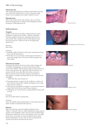 ABC of Dermatology
112
Chromomycosis
This chronic granulomatous condition mainly affects the legs
and results from infestation by a variety of parasitic fungi.
Large verrucous plaques may require surgical removal.
Histoplasmosis
This occurs in West Africa with nodules, ulcers, and bone
lesions developing due to infection with Histoplasma duboisii.
Treatment is with aphotericin B.
Infestations
Tungiasis
Invasion of the skin by sand fleas (Tunga penetrans) causes
tungiasis in tropical areas of Africa, America, and India.
It is most common on the feet, especially under the toes
and toenails. The condition looks a bit like plantar warts,
but if you watch for a while you will see the eggs being
squirted out.
Prevention
Wear shoes.
Treatment
• Carefully winkle the fleas out with a pin (most patients know
how to do this themselves).
• If the fleas are very extensive, soak the feet in kerosene or
treat with a single dose of ivermectin 200micrograms/kg
body weight.
Subcutaneous myiasis
Invasion of the skin by the larvae of the tumbu (mango) fly
(Cordylobia anthropophaga) in central and southern Africa
causes this condition. The fly lays her eggs on clothes layed out
to dry on the ground. The eggs hatch out two days later on
contact with the warm skin when the clothes are put on.
The larvae burrow into the skin causing a red painful or
itchy papule or nodule, predominantly on the trunk, buttocks,
and thighs.
Other flies that cause miyasis are:
• Dermatobia hominis—tropical bot fly, in Mexico, central, and
south America with tender nodules developing on the scalp,
legs, forearms, and face.
• Aucheronia sp.—Congo floor maggot, in central and southern
Africa. Bites of the larvae cause intense irritation.
• Callitroga sp. in central America causing inflamed lesions with
necrosis.
Prevention
Iron the clothes before wearing them.
Treatment
Cover the nodule with petroleum jelly or other grease; the larva
will be unable to breath and will crawl out.
Filariasis
This is an infestation with thread-like helminths (Latin
“Filum”—a thread). They are widely distributed in many species
and live in the lymphatics and connective tissue. Fertilised eggs
develop into embryonic worms—microfilariae. These are taken
up by insect vectors that act as intermediate hosts in which
further development occurs. They are then inoculated into
a human host when next bitten by the insect.
Chromomycosis
Histoplasmosis in HIV infection
Tungiasis
Myiasis—larvae
Myiasis—papule
 
