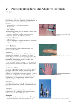 115
Skin lesions are easily accessible for removal or biopsy. The
procedure used needs to be appropriate to the site and type of
lesion involved. It is important also to keep scarring to a
minimum.
Destruction of skin lesions is carried out with:
• Electrocautery
• Cryotherapy
• Laser treatment
This is suitable for lesions where the diagnosis is certain, as no
specimen is available or histology.
Removal of skin lesions results in a specimen for the
pathologist to examine. The techniques used are:
• Curettage and cautery
• Surgical excision
• Incisional biopsy which provides a specimen for histology to
supplement the clinical diagnosis.
Cryotherapy
This involves the destruction of tissues by extreme cold.
Current methods used are:
Carbon dioxide
Solid carbon dioxide (temperature Ϫ64 ЊC) is produced by
allowing rapid expansion of the compressed gas from a
cylinder. This can be mixed with acetone to form a slush that
can be applied with a cotton wool bud. A solid carbon dioxide
stick, for direct application to lesions, is produced by an
apparatus using “sparklet” bulbs.
The lesion must be frozen solid with a 1–2mm margin of
surrounding tissue. After thawing the freezing cycle should be
repeated.
Liquid nitrogen (Ϫ196 ЊC)
This can be simply applied using a cotton wool bud dipped in
the vacuum flask of liquid nitrogen. Freezing takes a little
longer than using spray apparatus. Various types of such
apparatus are available with different sizes of nozzle. The larger
ones are used for seborrheoic keratoses on the back, for
example, and the smaller sizes for small lesions on the face.
Freezing takes a few seconds and after thawing a further
application can be made if necessary.
Ethyl chloride
This is sprayed directly on the skin, producing lowering of the
temperature and temporary analgesia. It is not generally used
for treatment.
Nitrous oxide
A cylinder of compressed gas is used to cool a probe to
approximately Ϫ80 ЊC. It is usually used for the treatment of
warts and requires a 30 second freezing cycle.
Precautions
• Cryotherapy produces pain and inflammation. Blistering and
haematoma may occur. This can be diminished by the
24 Practical procedures and where to use them
DWS Harris
Cryotherapy—applying the liquid
nitrogen
Cryotherapy—the frozen wart
Cryotherapy—subsequent slight
blistering
Cryotherapy—liquid nitrogen containers
 