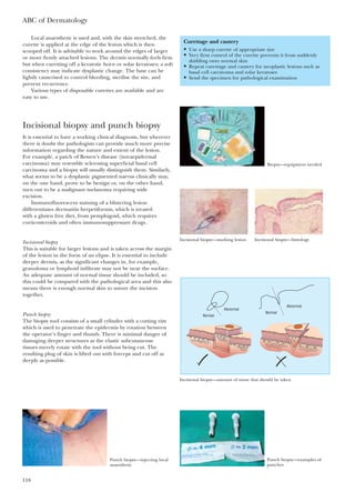 ABC of Dermatology
118
Local anaesthetic is used and, with the skin stretched, the
curette is applied at the edge of the lesion which is then
scooped off. It is advisable to work around the edges of larger
or more firmly attached lesions. The dermis normally feels firm
but when curetting off a keratotic horn or solar keratoses; a soft
consistency may indicate dysplastic change. The base can be
lightly cauterised to control bleeding, sterilise the site, and
prevent recurrence.
Various types of disposable curettes are available and are
easy to use.
Incisional biopsy and punch biopsy
It is essential to have a working clinical diagnosis, but wherever
there is doubt the pathologists can provide much more precise
information regarding the nature and extent of the lesion.
For example, a patch of Bowen’s disease (intraepidermal
carcinoma) may resemble sclerosing superficial basal cell
carcinoma and a biopsy will usually distinguish them. Similarly,
what seems to be a dysplastic pigmented naevus clinically may,
on the one hand, prove to be benign or, on the other hand,
turn out to be a malignant melanoma requiring wide
excision.
Immunofluorescent staining of a blistering lesion
differentiates dermatitis herpetiformis, which is treated
with a gluten free diet, from pemphigoid, which requires
corticosteroids and often immunosuppressant drugs.
Incisional biopsy
This is suitable for larger lesions and is taken across the margin
of the lesion in the form of an elipse. It is essential to include
deeper dermis, as the significant changes in, for example,
granuloma or lymphoid infiltrate may not be near the surface.
An adequate amount of normal tissue should be included, so
this could be compared with the pathological area and this also
means there is enough normal skin to suture the incision
together.
Punch biopsy
The biopsy tool consists of a small cylinder with a cutting rim
which is used to penetrate the epidermis by rotation between
the operator’s finger and thumb. There is minimal danger of
damaging deeper structures as the elastic subcutaneous
tissues merely rotate with the tool without being cut. The
resulting plug of skin is lifted out with forceps and cut off as
deeply as possible.
Curettage and cautery
• Use a sharp curette of appropriate size
• Very firm control of the curette prevents it from suddenly
skidding onto normal skin
• Repeat curettage and cautery for neoplastic lesions such as
basal cell carcinoma and solar keratoses
• Send the specimen for pathological examination
Biopsy—equipment needed
Incisional biopsy—marking lesion Incisional biopsy—histology
Normal
Abnormal
Normal
Abnormal
Incisional biopsy—amount of tissue that should be taken
Punch biopsy—examples of
punches
Punch biopsy—injecting local
anaesthetic
 