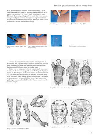 Practical procedures and where to use them
119
With the smaller sized punches the resulting defect can be
treated with electrocautery or left to heal spontaneously. With
a punch larger than 3 or 4mm a single suture can be used.
The main disadvantage of a punch biopsy is that it only provides
a single small piece of tissue. It may not be representative or
may miss an area of substantial change. It tends to leave a more
prominent scar than the incisional biopsy.
Punch biopsy—tool inserted Punch biopsy—plug of skin
Punch biopsy—raising plug of skin
to cut
Punch biopsy—treating defect with
electrocautery
Punch biopsy—specimen taken
Excision of skin lesions is both curative and diagnostic. It
may be the best way of making a diagnosis if there are multiple
small papules or vesicles, one of which can be excised intact.
Incisions should follow tension or wrinkle lines.
In the case of malignant lesions it is particularly important
that the whole lesion is adequately excised. The pathologist can
report on the adequacy of excision, but not in multifocal basal
cell carcinoma where this cannot be assessed. If there is likely
to be any doubt about the excision being complete it is helpful
to attach a suture to one end of the excised specimen so the
pathologist can describe which border, if any, extends over the
excision margin.
Surgical excision—“wrinkle lines” of skin
Surgical excision—“wrinkle lines” of skin
Surgical excision—“wrinkle lines” of skin
 