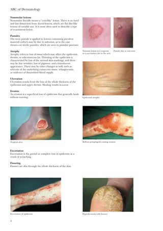 Nummular lesions
Nummular literally means a “coin-like” lesion. There is no hard
and fast distinction from discoid lesions, which are flat disc-like
lesions of variable size. It is most often used to describe a type
of eczematous lesion.
Pustules
The term pustule is applied to lesions containing purulent
material—which may be due to infection, as in the case
shown—or sterile pustules, which are seen in pustular psoriasis.
Atrophy
Atrophy refers to loss of tissue which may affect the epidermis,
dermis, or subcutaneous fat. Thinning of the epidermis is
characterised by loss of the normal skin markings, and there
may be fine wrinkles, loss of pigment, and a translucent
appearance. There may be other changes as well, such as
sclerosis of the underlying connective tissue, telangiectasia,
or evidence of diminished blood supply.
Ulceration
Ulceration results from the loss of the whole thickness of the
epidermis and upper dermis. Healing results in a scar.
Erosion
An erosion is a superficial loss of epidermis that generally heals
without scarring.
ABC of Dermatology
4
Numular lesion as a response
to a vaccination site in the arm
Pustule due to infection
Epidermal atrophy
Tropical ulcer Bullous pemphigoid causing erosion
Excoriation
Excoriation is the partial or complete loss of epidermis as a
result of scratching.
Fissuring
Fissures are slits through the whole thickness of the skin.
Excoriation of epidermis Hyperkeratosis with fissures
 