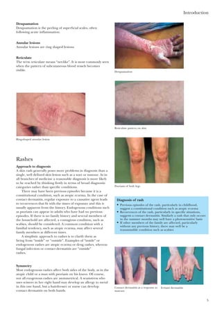 Desquamation
Desquamation is the peeling of superficial scales, often
following acute inflammation.
Annular lesions
Annular lesions are ring shaped lesions.
Reticulate
The term reticulate means “net-like”. It is most commonly seen
when the pattern of subcutaneous blood vessels becomes
visible.
Introduction
5
Desquamation
Ring-shaped annular lesion
Reticulate pattern on skin
Psoriasis of both legs
Rashes
Approach to diagnosis
A skin rash generally poses more problems in diagnosis than a
single, well defined skin lesion such as a wart or tumour. As in
all branches of medicine a reasonable diagnosis is more likely
to be reached by thinking firstly in terms of broad diagnostic
categories rather than specific conditions.
There may have been previous episodes because it is a
constitutional condition, such as atopic eczema. In the case of
contact dermatitis, regular exposure to a causative agent leads
to recurrences that fit with the times of exposure and this is
usually apparent from the history. Endogenous conditions such
as psoriasis can appear in adults who have had no previous
episodes. If there is no family history and several members of
the household are affected, a contagious condition, such as
scabies, should be considered. A common condition with a
familial tendency, such as atopic eczema, may affect several
family members at different times.
A simplistic approach to rashes is to clarify them as
being from “inside” or “outside”. Examples of “inside” or
endogenous rashes are atopic eczema or drug rashes, whereas
fungal infection or contact dermatitis are “outside”
rashes.
Symmetry
Most endogenous rashes affect both sides of the body, as in the
atopic child or a man with psoriasis on his knees. Of course,
not all exogenous rashes are asymmetrical. A seamstress who
uses scissors in her right hand may develop an allergy to metal
in this one hand, but a hairdresser or nurse can develop
contact dermatitis on both hands.
Contact dermatitis as a response to
mascara
Irritant dermatitis
Diagnosis of rash
• Previous episodes of the rash, particularly in childhood,
suggest a constitutional condition such as atopic eczema
• Recurrences of the rash, particularly in specific situations,
suggests a contact dermatitis. Similarly a rash that only occurs
in the summer months may well have a photosensitive basis
• If other members of the family are affected, particularly
without any previous history, there may well be a
transmissible condition such as scabies
 