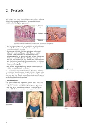 8
The familiar pink or red lesions with a scaling surface and well
defined edge are easily recognised. These changes can be
related to the histological appearance:
2 Psoriasis
Increased
thickness of
epidermis
Thick keratin
scale
Polymorphs
Dilated tortuous
blood vessels
Increased epidermal proliferation—nuclei found …throughout the epidermis
Pitting of the nail
Plaques Plaques
Large lesions
Small lesions
• The increased thickness of the epidermis, presence of nuclei
above the basal layer, and thick keratin are related to
increased epidermal turnover.
• Because the epidermis is dividing it does not differentiate
adequately into normal keratin scales. These are readily
removed to reveal the tortuous blood vessels beneath,
appearing clinically as “Auspitz sign”. The psoriatic plaque can
be likened to a brick wall badly built by a workman in too
much of a hurry—it may be high but it is easily knocked down.
• The polymorphs that migrate into the epidermis form sterile
pustules in pustular psoriasis. These are most commonly seen
on the palms and soles.
• The dilated blood vessels can be a main feature, giving the
clinical picture of intense erythema.
The equivalent changes in the nail cause thickening and “pits”
0.5–1.0mm in diameter on the surface; these are thought to be
due to small areas of psoriatic changes in the upper layer of the
nail plate that then fall out. Onycholysis, in which the nail plate
is raised up, also occurs in psoriasis.
Clinical appearance
The main characteristics of psoriatic lesions, which reflect the
pathological processes listed above, follow.
Plaques consisting of well defined raised areas of psoriasis.
These may be few or numerous, covering large areas of the
trunk and limbs. Sometimes there are large confluent lesions.
 