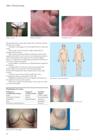 threatening. Close contact with adults with “cold sores” should
therefore be avoided.
Nummular eczema appears as coin shaped lesions on legs and
trunk.
Stasis eczema occurs around the ankles, where there is
impaired venous return.
Paget’s disease of the breast. Whereas bilateral eczema of the
nipples and areolae occur in women, any unilateral, persistent,
areas of dermatitis in this region may be caused by Paget’s
disease, in which there is underlying carcinoma of the ducts. In
such cases a biopsy is essential.
Lichen simplex is a localised area of lichenification produced
by rubbing.
Neurodermatitis is a term often used synonymously with
lichen simplex. It is also used to describe generalised
dryness and itching of the skin, usually in those with atopic
eczema.
Asteatotic eczema occurs in older people with a dry,
“crazypaving” pattern, particularly on the legs.
Pompholyx is itching vesicles on the fingers, with lesions on
the palms and soles in some patients.
Infection can modify the presentation of any type of eczema
or contact dermatitis.
ABC of Dermatology
18
Classification of eczema
Endogenous Exogenous Secondary
(constitutional) eczema (contact) eczema changes
Atopic Irritant Lichen simplex
Nummular or discoid Allergic Neurodermatitis
Pompholyx Photodermatitis Asteatosis
Stasis Pompholyx
Seborrhoeic (discussed later) Infection
Atopic eczema Plantar dermatosis Nummular eczema
Nummular eczema—distribution
Stasis eczema
Paget’s disease of the nipple Lichen simplex
 