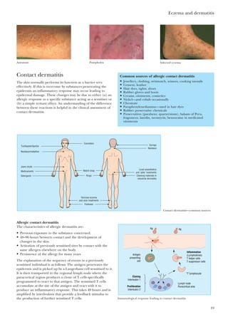 Contact dermatitis
The skin normally performs its function as a barrier very
effectively. If this is overcome by substances penetrating the
epidermis an inflammatory response may occur leading to
epidermal damage. These changes may be due to either (a) an
allergic response to a specific substance acting as a sensitiser or
(b) a simple irritant effect. An understanding of the difference
between these reactions is helpful in the clinical assessment of
contact dermatitis.
Eczema and dermatitis
19
Asteatosis Pompholyx Infected eczema
Common sources of allergic contact dermatitis
• Jewellery, clothing, wristwatch, scissors, cooking utensils
• Cement, leather
• Hair dyes, tights, shoes
• Rubber gloves and boots
• Creams, ointments, cosmetics
• Nickel—and cobalt occasionally
• Chromate
• Paraphenylenediamine—used in hair dyes
• Rubber preservative chemicals
• Preservatives (parabenz, quarternium), balsam of Peru,
fragrances, lanolin, neomycin, benzocaine in medicated
ointments
Toothpaste/lipstick
Necklace/medallion
Jeans studs
Medicaments
Detergents
Earings
Necklace
Local anaesthetics
and 'piles' treatments
Cleaning materials in
industrial dermatitis
Footwear
Rings
Watch strap
Cosmetics
Varicose eczema
and ulcer treatments
Contact dermatitis—common sources
Allergic contact dermatitis
The characteristics of allergic dermatitis are:
• Previous exposure to the substance concerned.
• 48–96 hours between contact and the development of
changes in the skin.
• Activation of previously sensitised sites by contact with the
same allergen elsewhere on the body.
• Persistence of the allergy for many years.
The explanation of the sequence of events in a previously
sensitised individual is as follows: The antigen penetrates the
epidermis and is picked up by a Langerhans cell sensitised to it.
It is then transported to the regional lymph node where the
paracortical region produces a clone of T cells specifically
programmed to react to that antigen. The sensitised T cells
accumulate at the site of the antigen and react with it to
produce an inflammatory response. This takes 48 hours and is
amplified by interleukins that provide a feedback stimulus to
the production of further sensitised T cells.
Ag
"T" lymphocyte
Lymph node
Paracortical area
Inflammation
(Lymphokines)
T helper cells
T suppressor cells
Cloning
Interleukin 1
Proliferation
Interleukin 2
Ag
Antigen
presenting
cell
Immunological response leading to contact dermatitis
 
