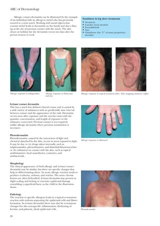 Allergic contact dermatitis can be illustrated by the example
of an individual with an allergy to nickel who has previously
reacted to a wrist watch. Working with metal objects that
contain nickel leads to dermatitis on the hands and also a flare
up at the site of previous contact with the watch. The skin
clears on holiday but the dermatitis recurs two days after the
person returns to work.
ABC of Dermatology
20
Sensitisers in leg ulcer treatments
• Neomycin
• Lanolin (wool alcohol)
• Formaldehyde
• Tars
• Chinaform (the “C” of many proprietary
steroids)
Allergic response to sulfapyridine Allergic response to Solarcaine
and sun
Allergic response to topical neomycin (left). After stopping ointment (right)
Irritant contact dermatitis
This has a much less defined clinical course and is caused by
a wide variety of substances with no predictable time interval
between contact and the appearance of the rash. Dermatitis
occurs soon after exposure and the severity varies with the
quantity, concentration, and length of exposure to the
substance concerned. Previous contact is not required,
unlike allergic dermatitis where previous sensitisation is
necessary.
Photodermatitis
Photodermatitis, caused by the interaction of light and
chemical absorbed by the skin, occurs in areas exposed to light.
It may be due to (a) drugs taken internally, such as
sulphonamides, phenothiazines, and dimethylchlortetracycline,
or (b) substances in contact with the skin, such as topical
antihistamines, local anaesthetics, cosmetics, and
antibacterials.
Morphology
The clinical appearance of both allergic and irritant contact
dermatitis may be similar, but there are specific changes that
help in differentiating them. An acute allergic reaction tends to
produce erythema, oedema, and vesicles. The more chronic
lesions are often lichenified. Irritant dermatitis may present as
slight scaling and itching or extensive epidermal damage
resembling a superficial burn, as the child in the illustration
shows.
Pathology
The reaction to specific allergens leads to a typical eczematous
reaction with oedema separating the epidermal cells and blister
formation. In irritant dermatitis there may also be eczematous
changes but also non-specific inflammation, thickening of
keratin, and pyknotic, dead epidermal cells. Photodermatitis
Allergic response to dithranol
 