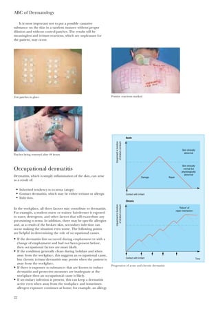 It is most important not to put a possible causative
substance on the skin in a random manner without proper
dilution and without control patches. The results will be
meaningless and irritant reactions, which are unpleasant for
the patient, may occur.
ABC of Dermatology
22
Test patches in place
Patches being removed after 48 hours
Positive reactions marked
Occupational dermatitis
Dermatitis, which is simply inflammation of the skin, can arise
as a result of:
In the workplace, all three factors may contribute to dermatitis.
For example, a student nurse or trainee hairdresser is exposed
to water, detergents, and other factors that will exacerbate any
pre-existing eczema. In addition, there may be specific allergies
and, as a result of the broken skin, secondary infection can
occur making the situation even worse. The following points
are helpful in determining the role of occupational causes.
• If the dermatitis first occurred during employment or with a
change of employment and had not been present before,
then occupational factors are more likely.
• If the condition generally clears during holidays and when
away from the workplace, this suggests an occupational cause,
but chronic irritant dermatitis may persist when the patient is
away from the workplace.
• If there is exposure to substances that are known to induce
dermatitis and protective measures are inadequate at the
workplace then an occupational cause is likely.
• If secondary infection is present, this can keep a dermatitis
active even when away from the workplace and sometimes
allergen exposure continues at home; for example, an allergy
Contact with irritant Time
Contact with irritant
Acute
Damage Repair
"Failure" of
repair mechanism
Skin clinically
normal but
physiologically
abnormal
Skin clinically
abnormal
Chronic
Impairmentinfunction
ofstratumcorneum
Impairmentinfunction
ofstratumcorneum
Progression of acute and chronic dermatitis
• Inherited tendency to eczema (atopy)
• Contact dermatitis, which may be either irritant or allergic
• Infection.
 