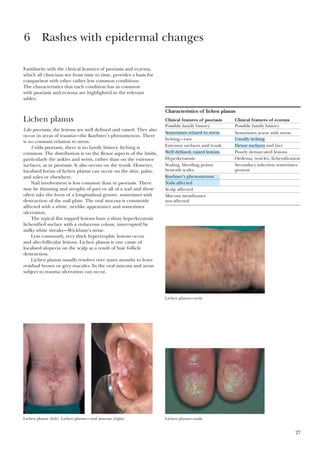 27
Familiarity with the clinical features of psoriasis and eczema,
which all clinicians see from time to time, provides a basis for
comparison with other rather less common conditions.
The characteristics that each condition has in common
with psoriasis and eczema are highlighted in the relevant
tables.
Lichen planus
Like psoriasis, the lesions are well defined and raised. They also
occur in areas of trauma—the Koebner’s phenomenon. There
is no constant relation to stress.
Unlike psoriasis, there is no family history. Itching is
common. The distribution is on the flexor aspects of the limbs,
particularly the ankles and wrists, rather than on the extensor
surfaces, as in psoriasis. It also occurs on the trunk. However,
localised forms of lichen planus can occur on the shin, palm,
and soles or elsewhere.
Nail involvement is less common than in psoriasis. There
may be thinning and atrophy of part or all of a nail and these
often take the form of a longitudinal groove, sometimes with
destruction of the nail plate. The oral mucosa is commonly
affected with a white, net-like appearance and sometimes
ulceration.
The typical flat topped lesions have a shiny hyperkeratotic
lichenified surface with a violaceous colour, interrupted by
milky white streaks—Wickham’s striae.
Less commonly, very thick hypertrophic lesions occur
and also follicular lesions. Lichen planus is one cause of
localised alopecia on the scalp as a result of hair follicle
destruction.
Lichen planus usually resolves over many months to leave
residual brown or grey macules. In the oral mucosa and areas
subject to trauma ulceration can occur.
6 Rashes with epidermal changes
Characteristics of lichen planus
Clinical features of psoriasis Clinical features of eczema
Possible family history Possible family history
Sometimes worse with stress
Itching—rare
Extensor surfaces and trunk
Poorly demarcated lesions
Hyperkeratosis Oedema, vesicles, lichenification
Scaling, bleeding points Secondary infection sometimes
beneath scales present
Scalp affected
Mucous membranes
not affected
Lichen planus—wrist
Lichen planus (left). Lichen planus—oral mucosa (right) Lichen planus—nails
Sometimes related to stress
Usually itching
Flexor surfaces and face
Well defined, raised lesions
Koebner’s phenomenon
Nails affected
 