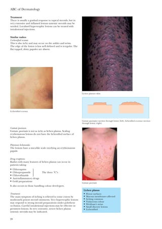 ABC of Dermatology
28
Treatment
There is usually a gradual response to topical steroids, but in
very extensive and inflamed lesions systemic steroids may be
needed. Localised hypertrophic lesions can be treated with
intralesional injections.
Similar rashes
Lichenified eczema
This is also itchy and may occur on the ankles and wrists.
The edge of the lesion is less well defined and is irregular. The
flat topped, shiny papules are absent.
Lichen planus—skin
Lichenified eczema
Guttate psoriasis—section through lesion (left); lichenified eczema—section
through lesion (right)
Guttate psoriasis
Lichen planus
• Flexor surfaces
• Mucous membranes affected
• Itching common
• Violaceous colour
• Wickham’s striae
• Small discrete lesions
• Lichenified
Guttate psoriasis
Guttate psoriasis is not as itchy as lichen planus. Scaling
erythematous lesions do not have the lichenified surface of
lichen planus.
Pityriasis lichenoides
The lesions have a mica-like scale overlying an erythematous
papule.
Drug eruptions
Rashes with many features of lichen planus can occur in
patients taking:
• Chloroquine
• Chlorpropamide
} The three “C”s
• Chlorothiazide
• Anti-inflammatory drugs
• Gold preparations
It also occurs in those handling colour developers.
Treatment
The main symptom of itching is relieved to some extent by
moderately potent steroid ointments. Very hypertrophic lesions
may respond to strong steroid preparations under polythene
occlusion. Careful intralesional injections may be effective in
persistent lesions. In very extensive, severe lichen planus
systemic steroids may be indicated.
 