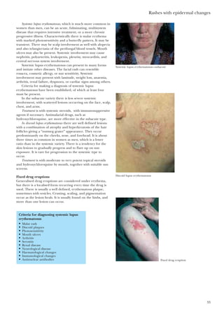 Systemic lupus erythematosus, which is much more common in
women than men, can be an acute, fulminating, multisystem
disease that requires intensive treatment, or a more chronic
progressive illness. Characteristically there is malar erythema
with marked photosensitivity and a butterfly pattern. It may be
transient. There may be scalp involvement as well with alopecia
and also telangiectasia of the perifungal blood vessels. Mouth
ulcers may also be present. Systemic involvement may cause
nephritis, polyarteritis, leukopenia, pleurisy, myocarditis, and
central nervous system involvement.
Systemic lupus erythematosus can present in many forms
and imitate other diseases. The facial rash can resemble
rosacea, cosmetic allergy, or sun sensitivity. Systemic
involvement may present with lassitude, weight loss, anaemia,
arthritis, renal failure, dyspnoea, or cardiac signs among others.
Criteria for making a diagnosis of systemic lupus
erythematosus have been established, of which at least four
must be present.
In the subacute variety there is less severe systemic
involvement, with scattered lesions occurring on the face, scalp,
chest, and arms.
Treatment is with systemic steroids, with immunosuppressive
agents if necessary. Antimalarial drugs, such as
hydroxychloroquine, are more effective in the subacute type.
In discoid lupus erythematosus there are well defined lesions
with a combination of atrophy and hyperkeratosis of the hair
follicles giving a “nutmeg grater” appearance. They occur
predominantly on the cheeks, nose, and forehead. It is about
three times as common in women as men, which is a lower
ratio than in the systemic variety. There is a tendency for the
skin lesions to gradually progress and to flare up on sun
exposure. It is rare for progression to the systemic type to
occur.
Treatment is with moderate to very potent topical steroids
and hydroxychloroquine by mouth, together with suitable sun
screens.
Fixed drug eruptions
Generalised drug eruptions are considered under erythema,
but there is a localised form recurring every time the drug is
used. There is usually a well defined, erythematous plaque,
sometimes with vesicles. Crusting, scaling, and pigmentation
occur as the lesion heals. It is usually found on the limbs, and
more than one lesion can occur.
Rashes with epidermal changes
33
Systemic lupus erythematosus—subacute
Discoid lupus erythematosus
Fixed drug eruption
Criteria for diagnosing systemic lupus
erythematosus
• Malar rash
• Discoid plaques
• Photosensitivity
• Mouth ulcers
• Arthritis
• Serositis
• Renal disease
• Neurological disease
• Haematological changes
• Immunological changes
• Antinuclear antibodies
 