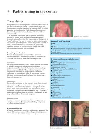 35
The erythemas
Complex reactions occurring in the capillaries and arterioles of
the skin cause erythema, which is simply redness of the skin.
This may present as flat macules or as papules, which are raised
above the surrounding skin. The lesions may be transient or
last for weeks, constant or variable in distribution, with or
without vesicles.
It is possible to recognise specific patterns within this
plethora of clinical signs, but even the most experienced
dermatologist may be reduced to making a general diagnosis of
“toxic” erythema. The best we can do therefore is to recognise
the common types of erythema and list the possible causes. It is
then a matter of deciding on the most likely underlying
condition or group of conditions—for example, bacterial
infection or autoimmune systemic disease.
Morphology and distribution
Because there can be the same cause for a variety of
erythematous rashes detailed descriptions are of limited use.
None the less, there are some characteristic patterns.
Morbilliform
The presentation of measles is well known, with the appearance
of Koplik’s spots on the mucosa, photophobia with
conjunctivitis, and red macules behind the ears, spreading to
the face, trunk, and limbs. The prodromal symptoms and
conjunctivitis are absent in drug eruptions. Other viral
conditions, including those caused by echoviruses, rubella,
infectious mononucleosis, and erythema infectiosum, may
have to be considered.
Scarlatiniform
These rashes are similar to that in scarlet fever, when an acute
erythematous eruption occurs in relation to a streptococcal
infection. Characteristically erythema is widespread on the
trunk. There is intense erythema and engorgement of the
pharyngeal lymphoid tissue with an exudate and a “strawberry”
tongue. Bacterial infections can produce a similar rash, as can
drug rashes, without the systemic symptoms.
Figurate erythemas
These are chronic erythematous rashes forming annular or
serpiginous patterns. There may be underlying malignancy
or connective tissue disease.
Erythema multiforme
Erythema multiforme is sometimes misdiagnosed because of the
variety of lesions and number of possible precipitating causes;
some of these are listed in the box on the right.
7 Rashes arising in the dermis
Causes of “toxic” erythema
Drugs
• Antibiotics, barbiturates, thiazides
Infections
• Any recent infections such as streptococcal throat infection or
erysipelas; spirochaetal infections; viral infections
Systemic causes
• Pregnancy; connective tissue disease; malignancy
Erythema multiforme: precipitating causes
Infections
• Herpes simplex—the commonest cause
• Mycoplasma infection
• Infectious mononucleosis
• Poliomyelitis (vaccine)
• Many other viral and bacterial infections
• Any focal sepsis
• BCG inoculaton
Collagen disease
• Systemic lupus erythematosus
• Polyarteritis nodosa
Neoplasia
• Hodgkin’s disease
• Myeloma
• Carcinoma
Chronic inflammation
• Sarcoidosis
• Wegener’s granuloma
Drugs
• Barbiturates
• Sulphonamides
• Penicillin
• Phenothiazine and many others
Erythema from antibiotics
Erythema multiforme Erythema multiforme
 