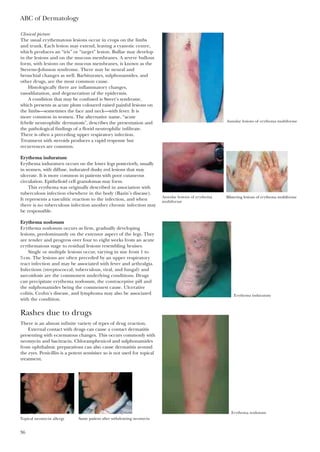 ABC of Dermatology
36
Clinical picture
The usual erythematous lesions occur in crops on the limbs
and trunk. Each lesion may extend, leaving a cyanotic centre,
which produces an “iris” or “target” lesion. Bullae may develop
in the lesions and on the mucous membranes. A severe bullous
form, with lesions on the mucous membranes, is known as the
Stevens–Johnson syndrome. There may be neural and
bronchial changes as well. Barbiturates, sulphonamides, and
other drugs, are the most common cause.
Histologically there are inflammatory changes,
vasodilatation, and degeneration of the epidermis.
A condition that may be confused is Sweet’s syndrome,
which presents as acute plum coloured raised painful lesions on
the limbs—sometimes the face and neck—with fever. It is
more common in women. The alternative name, “acute
febrile neutrophilic dermatosis”, describes the presentation and
the pathological findings of a florid neutrophilic infiltrate.
There is often a preceding upper respiratory infection.
Treatment with steroids produces a rapid response but
recurrences are common.
Erythema induratum
Erythema induraturn occurs on the lower legs posteriorly, usually
in women, with diffuse, indurated dusky red lesions that may
ulcerate. It is more common in patients with poor cutaneous
circulation. Epithelioid cell granulomas may form.
This erythema was originally described in association with
tuberculous infection elsewhere in the body (Bazin’s disease).
It represents a vasculitic reaction to the infection, and when
there is no tuberculous infection another chronic infection may
be responsible.
Erythema nodosum
Erythema nodosum occurs as firm, gradually developing
lesions, predominantly on the extensor aspect of the legs. They
are tender and progress over four to eight weeks from an acute
erythematous stage to residual lesions resembling bruises.
Single or multiple lesions occur, varying in size from 1 to
5cm. The lesions are often preceded by an upper respiratory
tract infection and may be associated with fever and arthralgia.
Infections (streptococcal, tuberculous, viral, and fungal) and
sarcoidosis are the commonest underlying conditions. Drugs
can precipitate erythema nodosum, the contraceptive pill and
the sulphonamides being the commonest cause. Ulcerative
colitis, Crohn’s disease, and lymphoma may also be associated
with the condition.
Rashes due to drugs
There is an almost infinite variety of types of drug reaction.
External contact with drugs can cause a contact dermatitis
presenting with eczematous changes. This occurs commonly with
neomycin and bacitracin. Chloramphenicol and sulphonamides
from ophthalmic preparations can also cause dermatitis around
the eyes. Penicillin is a potent sensitiser so is not used for topical
treatment.
Annular lesions of erythema multiforme
Annular lesions of erythema
multiforme
Blistering lesions of erythema multiforme
Erythema induratum
Erythema nodosum
Topical neomycin allergy Same patient after withdrawing neomycin
 