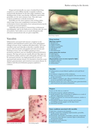 Rashes arising in the dermis
37
Drugs used systemically can cause a localised fixed drug
eruption or a more diffuse macular or papular erythema,
symmetrically distributed. In the later stages exfoliation, with
shedding scales of skin, may develop. Antibiotics, particularly
penicillins, are the most common cause. They also cause
erythema multiforme as already mentioned.
Penicillins are the most common cause of drug rashes,
which range from acute anaphylaxis to persistent diffuse
erythematous lesions. Joint pains, fever, and proteinuria may be
associated, as in serum sickness.
Ampicillin often produces a characteristic erythematous
maculopapular rash on the limbs seven to 20 days after the start
of treatment. Such rashes occur in nearly all patients with
infectious mononucleosis who are given ampicillin.
Vasculitis
Inflammation associated with immune complexes in the
capillaries and small blood vessels is part of the pathological
changes of many of the conditions described above. The term
vasculitis is also used clinically to describe a variable clinical
picture with red macules and papules and with necrosis and
bruising in severe cases. In children purpura is more
prominent and these cases are classified as Henoch–Schönlein
purpura. The legs and arms are usually affected. Skin signs are
preceded by malaise and fever with arthropathy and there may
be associated urticaria. As a high proportion of cases are
associated with systemic lesions, it is essential to check for renal,
skeletal, gastrointestinal, and central nervous system disease. In
children with Henoch–Schönlein purpura nephritis is
common.
Fixed drug eruption
Drug reactions
Blistering eruptions
• Barbiturates
• Sulphonamides
• Iodines or bromides
• Chlorpropamide
• Salicylates
• Phenylbutazone
Lichen planus like reactions
• Chloroquine
• Chlorothiazide
• Chlorpropamide
Photosensitivity (seen on areas exposed to light)
• Thiazide diuretics
• Sulphonamides
• Tetracyclines
Vasculitis
• Inflammation around dilated capillaries and small blood
vessels
• A common component of the erythemas
• May occur as red macules and papules with necrotic lesions
on the extremities
• In children a purpuric type (Henoch–Schönlein purpura)
occurs in association with nephritis
• Systemic lesions may occur, with renal, joint, gastrointestinal,
and central nervous system involvement
Purpura
Is seen on the skin as a result of:
• Thrombocytopenia—platelet deficiency
• Senile purpura—due to shearing of capillaries as a result of
defective supporting connective tissue
• Purpura in patients on corticosteroid treatment—similar to
senile purpura
• Schamberg’s disease—brown macules and red spots
resembling cayenne pepper on the legs of men
• Associated vasculitis
Some conditions associated with vasculitis
• Infection—streptococcal, hepatitis
• Drugs—numerous, including sulphonamides, penicillin,
phenothiazine, phenacitin
• Chemicals—insecticides, weed killers, phenolic compounds
• Connective tissue diseases—systemic lupus erythematosus,
rheumatoid arthritis
• Lymphoma and leukaemia
• Dysproteinaemias
Vasculitis
Acute vasculitis with necrosis Necrotising angiitis
 