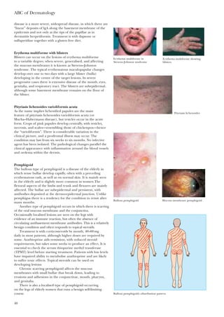 disease is a more severe, widespread disease, in which there are
“linear” deposits of lgA along the basement membrane of the
epidermis and not only at the tips of the papillae as in
dermatitis herpetiformis. Treatment is with dapsone or
sulfapyridine together with a gluten free diet.
Erythema multiforme with blisters
Blisters can occur on the lesions of erythema multiforme
to a variable degree; when severe, generalised, and affecting
the mucous membranes it is known as Stevens–Johnson
syndrome. The typical erythematous maculopapular changes
develop over one to two days with a large blister (bulla)
developing in the centre of the target lesions. In severe
progressive cases there is extensive disease of the mouth, eyes,
genitalia, and respiratory tract. The blisters are subepidermal,
although some basement membrane remains on the floor of
the blister.
Pityriasis lichenoides varioliformis acuta
As the name implies lichenified papules are the main
feature of pityriasis lichenoides varioliformis acuta (or
Mucha–Habermann disease), but vesicles occur in the acute
form. Crops of pink papules develop centrally, with vesicles,
necrosis, and scales—resembling those of chickenpox—hence
the “varioliformis”. There is considerable variation in the
clinical picture, and a prodromal illness may occur. The
condition may last from six weeks to six months. No infective
agent has been isolated. The pathological changes parallel the
clinical appearance with inflammation around the blood vessels
and oedema within the dermis.
Pemphigoid
The bullous type of pemphigoid is a disease of the elderly in
which tense bullae develop rapidly, often with a preceding
erythematous rash, as well as on normal skin. It is mainly seen
in the elderly and is slightly more common in women.The
flexural aspects of the limbs and trunk and flexures are mainly
affected. The bullae are subepidermal and persistent, with
antibodies deposited at the dermo-epidermal junction. Unlike
pemphigus there is a tendency for the condition to remit after
many months.
Another type of pemphigoid occurs in which there is scarring
of the oral mucous membrane and the conjunctiva.
Occasionally localised lesions are seen on the legs with
evidence of an immune reaction, but often the absence of
circulating antibasement membrane antibodies. This is a relatively
benign condition and often responds to topical steroids.
Treatment is with corticosteroids by mouth, 40–60mg
daily in most patients, although higher doses are required by
some. Azathioprine aids remission, with reduced steroid
requirements, but takes some weeks to produce an effect. It is
essential to check the serum thiopurine methyl transferase
(TPMT) level before starting treatment. Patients with low levels
have impaired ability to metabolise azathioprine and are likely
to suffer toxic effects. Topical steroids can be used on
developing lesions.
Chronic scarring pemphigoid affects the mucous
membranes with small bullae that break down, leading to
erosions and adhesions in the conjunctivae, mouth, pharynx,
and genitalia.
There is also a localised type of pemphigoid occurring
on the legs of elderly women that runs a benign self-limiting
course.
ABC of Dermatology
40
Erythema multiforme in
Stevens–Johnson syndrome
Erythema multiforme showing
blisters
Pityriasis lichenoides
Mucous membrane pemphigoidBullous pemphigoid
Bullous pemphigoid—distribution pattern
 