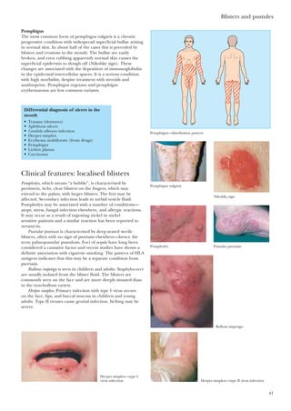 Pemphigus
The most common form of pemphigus vulgaris is a chronic
progressive condition with widespread superficial bullae arising
in normal skin. In about half of the cases this is preceded by
blisters and erosions in the mouth. The bullae are easily
broken, and even rubbing apparently normal skin causes the
superficial epidermis to slough off (Nikolsky sign). These
changes are associated with the deposition of immunoglobulin
in the epidermal intercellular spaces. It is a serious condition
with high morbidity, despite treatment with steroids and
azathioprine. Pemphigus vegetans and pemphigus
erythematosus are less common variants.
Blisters and pustules
41
Pemphigus—distribution pattern
Pemphigus vulgaris
Nikolsky sign
Pompholyx Pustular psoriasis
Bullous impetigo
Herpes simplex—type II virus infection
Herpes simplex—type I
virus infection
Differential diagnosis of ulcers in the
mouth
• Trauma (dentures)
• Aphthous ulcers
• Candida albicans infection
• Herpes simplex
• Erythema multiforme (from drugs)
• Pemphigus
• Lichen planus
• Carcinoma
Clinical features: localised blisters
Pompholyx, which means “a bubble”, is characterised by
persistent, itchy, clear blisters on the fingers, which may
extend to the palms, with larger blisters. The feet may be
affected. Secondary infection leads to turbid vesicle fluid.
Pompholyx may be associated with a number of conditions—
atopy, stress, fungal infection elsewhere, and allergic reactions.
It may occur as a result of ingesting nickel in nickel
sensitive patients and a similar reaction has been reported to
neomycin.
Pustular psoriasis is characterised by deep seated sterile
blisters, often with no sign of psoriasis elsewhere—hence the
term palmopustular pustulosis. Foci of sepsis have long been
considered a causative factor and recent studies have shown a
definite association with cigarette smoking. The pattern of HLA
antigens indicates that this may be a separate condition from
psoriasis.
Bullous impetigo is seen in children and adults. Staphylococci
are usually isolated from the blister fluid. The blisters are
commonly seen on the face and are more deeply situated than
in the non-bullous variety.
Herpes simplex. Primary infection with type 1 virus occurs
on the face, lips, and buccal mucosa in children and young
adults. Type II viruses cause genital infection. Itching may be
severe.
 