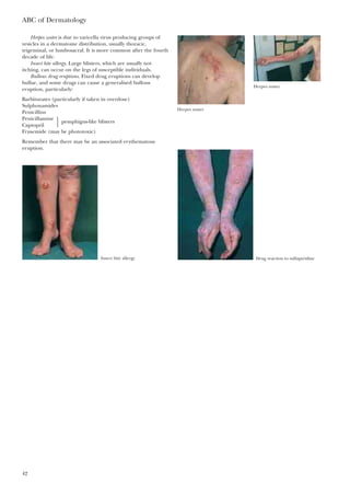 Herpes zoster is due to varicella virus producing groups of
vesicles in a dermatome distribution, usually thoracic,
trigeminal, or lumbosacral. It is more common after the fourth
decade of life.
Insect bite allergy. Large blisters, which are usually not
itching, can occur on the legs of susceptible individuals.
Bullous drug eruptions. Fixed drug eruptions can develop
bullae, and some drugs can cause a generalised bullous
eruption, particularly:
Barbiturates (particularly if taken in overdose)
Sulphonamides
Penicillins
Penicillamine
} pemphigus-like blisters
Captopril
Frusemide (may be phototoxic)
Remember that there may be an associated erythematous
eruption.
ABC of Dermatology
42
Herpes zoster
Herpes zoster
Insect bite allergy Drug reaction to sulfapyridine
 