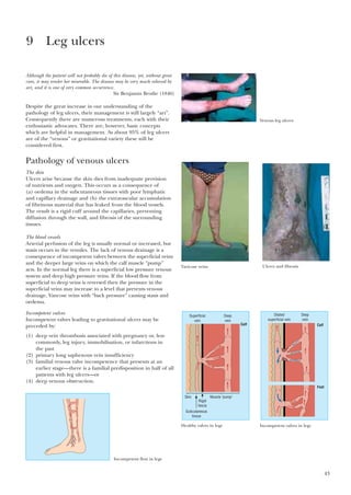 43
Although the patient will not probably die of this disease, yet, without great
care, it may render her miserable. The disease may be very much relieved by
art, and it is one of very common occurrence.
Sir Benjamin Brodie (1846)
Despite the great increase in our understanding of the
pathology of leg ulcers, their management is still largely “art”.
Consequently there are numerous treatments, each with their
enthusiastic advocates. There are, however, basic concepts
which are helpful in management. As about 95% of leg ulcers
are of the “venous” or gravitational variety these will be
considered first.
Pathology of venous ulcers
The skin
Ulcers arise because the skin dies from inadequate provision
of nutrients and oxygen. This occurs as a consequence of
(a) oedema in the subcutaneous tissues with poor lymphatic
and capillary drainage and (b) the extravascular accumulation
of fibrinous material that has leaked from the blood vessels.
The result is a rigid cuff around the capillaries, preventing
diffusion through the wall, and fibrosis of the surrounding
tissues.
The blood vessels
Arterial perfusion of the leg is usually normal or increased, but
stasis occurs in the venules. The lack of venous drainage is a
consequence of incompetent valves between the superficial veins
and the deeper large veins on which the calf muscle “pump”
acts. In the normal leg there is a superficial low pressure venous
system and deep high pressure veins. If the blood flow from
superficial to deep veins is reversed then the pressure in the
superficial veins may increase to a level that prevents venous
drainage, Vancose veins with “back pressure” causing stasis and
oedema.
Incompetent valves
Incompetent valves leading to gravitational ulcers may be
preceded by:
(1) deep vein thrombosis associated with pregnancy or, less
commonly, leg injury, immobilisation, or infarctions in
the past
(2) primary long saphenous vein insufficiency
(3) familial venous valve incompetence that presents at an
earlier stage—there is a familial predisposition in half of all
patients with leg ulcers—or
(4) deep venous obstruction.
9 Leg ulcers
Venous leg ulcers
Varicose veins Ulcers and fibrosis
Superficial
vein
Skin
Subcutaneous
tissue
Muscle "pump"
Rigid
fascia
Deep
vein
Calf
Healthy valves in legs
Dilated
superficial vein
Deep
vein
Calf
Foot
Incompetent valves in legs
Incompetent flow in legs
 