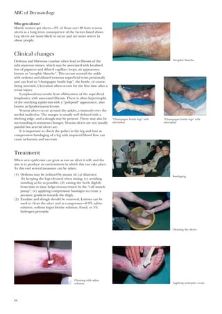 ABC of Dermatology
44
Who gets ulcers?
Mainly women get ulcers—2% of those over 80 have venous
ulcers as a long term consequence of the factors listed above.
Leg ulcers are more likely to occur and are more severe in
obese people.
Clinical changes
Oedema and fibrinous exudate often lead to fibrosis of the
subcutaneous tissues, which may be associated with localised
loss of pigment and dilated capillary loops, an appearance
known as “atrophic blanche”. This occurs around the ankle
with oedema and dilated tortuous superficial veins proximally
and can lead to “champagne bottle legs”, the bottle, of course,
being inverted. Ulceration often occurs for the first time after a
trivial injury.
Lymphoedema results from obliteration of the superficial
lymphatics, with associated fibrosis. There is often hypertrophy
of the overlying epidermis with a “polypoid” appearance, also
known as lipodermatosclerosis.
Venous ulcers occur around the ankles, commonly over the
medial malleolus. The margin is usually well defined with a
shelving edge, and a slough may be present. There may also be
surrounding eczematous changes. Venous ulcers are not usually
painful but arterial ulcers are.
It is important to check the pulses in the leg and foot as
compression bandaging of a leg with impaired blood flow can
cause ischaemia and necrosis.
Treatment
When new epidermis can grow across an ulcer it will, and the
aim is to produce an environment in which this can take place.
To this end several measures can be taken:
(1) Oedema may be reduced by means of: (a) diuretics;
(b) keeping the legs elevated when sitting; (c) avoiding
standing as far as possible; (d) raising the heels slightly
from time to time helps venous return by the “calf muscle
pump”; (e) applying compression bandages to create a
pressure gradient towards the thigh.
(2) Exudate and slough should be removed. Lotions can be
used to clean the ulcer and as compresses—0·9% saline
solution, sodium hypochlorite solution, Eusol, or 5%
hydrogen peroxide.
Atrophie blanche
“Champagne bottle legs” with
ulceration
“Champagne bottle legs” with
ulceration
Bandaging
Cleaning the ulcers
Applying antiseptic cream
Cleaning with saline
solution
 