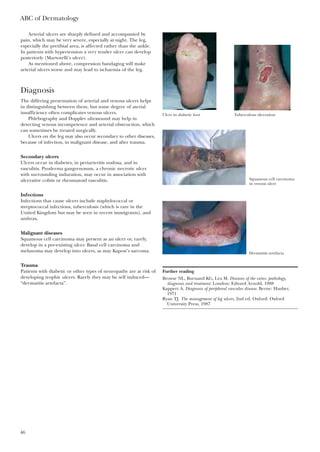 ABC of Dermatology
46
Arterial ulcers are sharply defined and accompanied by
pain, which may be very severe, especially at night. The leg,
especially the pretibial area, is affected rather than the ankle.
In patients with hypertension a very tender ulcer can develop
posteriorly (Martorelli’s ulcer).
As mentioned above, compression bandaging will make
arterial ulcers worse and may lead to ischaemia of the leg.
Diagnosis
The differing presentation of arterial and venous ulcers helps
in distinguishing between them, but some degree of aterial
insufficiency often complicates venous ulcers.
Phlebography and Doppler ultrasound may help in
detecting venous incompetence and arterial obstruction, which
can sometimes be treated surgically.
Ulcers on the leg may also occur secondary to other diseases,
because of infection, in malignant disease, and after trauma.
Secondary ulcers
Ulcers occur in diabetes, in periarteritis nodosa, and in
vasculitis. Pyoderma gangrenosum, a chronic necrotic ulcer
with surrounding induration, may occur in association with
ulcerative colitis or rheumatoid vasculitis.
Infections
Infections that cause ulcers include staphylococcal or
streptococcal infections, tuberculosis (which is rare in the
United Kingdom but may be seen in recent immigrants), and
anthrax.
Malignant diseases
Squamous cell carcinoma may present as an ulcer or, rarely,
develop in a pre-existing ulcer. Basal cell carcinoma and
melanoma may develop into ulcers, as may Kaposi’s sarcoma.
Trauma
Patients with diabetic or other types of neuropathy are at risk of
developing trophic ulcers. Rarely they may be self induced—
“dermatitis artefacta”.
Further reading
Browse NL, Burnand KG, Lea M. Diseases of the veins: pathology,
diagnosis and treatment. London: Edward Arnold, 1988
Kappert A. Diagnosis of peripheral vascular disease. Berne: Hauber,
1971
Ryan TJ. The management of leg ulcers, 2nd ed. Oxford: Oxford
University Press, 1987
Ulcer in diabetic foot Tuberculous ulceration
Squamous cell carcinoma
in venous ulcer
Dermatitis artefacta
 