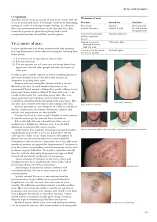 Acne and rosacea
49
Occupational
Acne-like lesions occur as a result of long term contact with oils
or tar as mentioned above. This usually results from lubricating,
cutting, or crude oil soaking through clothing. In chloracne
there are prominent comedones on the face and neck. It is
caused by exposure to polychlortriphenyl and related
compounds and also to weedkiller and dicophane.
Treatment of acne
In most adolescents acne clears spontaneously with minimal
scarring. Reassurance and explanation along the following lines
helps greatly:
(1) The lesions can be expected to clear in time.
(2) It is not infectious.
(3) The less patients are self conscious and worry about their
appearance the less other people will take any notice of
their acne.
It helps to give a simple regimen to follow, enabling patients to
take some positive steps to clear their skin and also an
alternative to picking their spots.
Patients with acne should be advised to hold a hot wet
flannel on the face (a much simpler alternative to the
commercial “Facial saunas”), followed by gentle rubbing in of a
plain soap. Savlon solution, diluted 10 times with water, is an
excellent alternative for controlling greasy skin. There are
many proprietary preparations, most of which act as
keratolytics, dissolving the keratin plug of the comedone. They
can also cause considerable dryness and scaling of the skin.
Benzoyl peroxide in concentrations of 1–10% is available as
lotions, creams, gels, and washes. Resorcinol, sulphur, and
salicylic acid preparations are also available.
Vitamin A acid as a cream or gel is helpful in some patients.
A topical tretinoin gel has recently been introduced.
Ultraviolet light therapy is less effective than natural
sunlight but is helpful for extensive acne. It is a helpful
additional treatment in the winter months.
Oral treatment. The mainstay of treatment is oxytetracycline,
which should be given for a week at 1g daily then 500mg
(250mg twice daily) on an empty stomach. Minocycline or
doxycycline are alternatives that can be taken with food.
Perseverance with treatment is important, and it may take some
months to produce an appreciable improvement. Erythromycin
is an alternative to tetracycline, and co-trimoxazole can be used
for Gram negative folliculitis. Tetracycline might theoretically
interfere with the absorption of progesterone types of birth
control pill and should not be given in pregnancy.
Topical antibiotics. Erythromycin, the tetracyclines, and
clindamycin have been used topically. There is the risk of
producing colonies of resistant organisms.
Antiandrogens. Cyproterone acetate combined with
ethinyloestradiol is effective in some women; it is also
a contraceptive.
Synthetic retinoids. For severe cases resistant to other
treatments these drugs, which can be prescribed only in
hospital, are very effective and clear most cases in a few
months. 13-cis-Retinoic acid (isotretinoin) is usually used for
acne. They are teratogenic, so there must be no question of
pregnancy, and can cause liver changes with raised serum lipid
values. Regular blood tests are therefore essential. A three
month course of treatment usually gives a long remission.
Recently topical isotretinoin gel has been introduced.
Residual lesions, keloid scars, cysts, and persistent nodules
can be treated by injection with triamcinolone or freezing with
Treatment of acne
First line Second line Third line
Encourage Topical Oral retinoids
positive attitudes vitamin A acid for 3–4 months
(hospitals only)
Avoid environmental Topical antibiotics
and occupational
factors
Topical treatment Ultraviolet light
Benzoyl peroxide
Salicylic acid
A tetracycline by mouth Antiandrogens
for several months
Acne before treatment
Acne after treatment
Severe cystic acne before (left) and after (right) treatment with tetracycline
Keloid scars
Keloid scars on dark skin
 