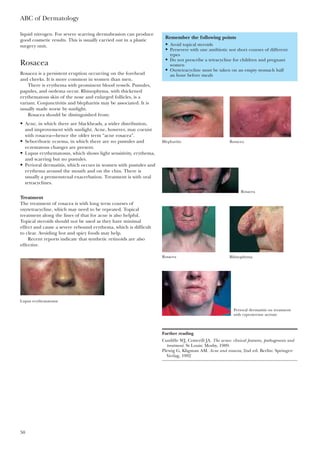 ABC of Dermatology
50
liquid nitrogen. For severe scarring dermabrasion can produce
good cosmetic results. This is usually carried out in a plastic
surgery unit.
Rosacea
Rosacea is a persistent eruption occurring on the forehead
and cheeks. It is more common in women than men.
There is erythema with prominent blood vessels. Pustules,
papules, and oedema occur. Rhinophyma, with thickened
erythematous skin of the nose and enlarged follicles, is a
variant. Conjunctivitis and blepharitis may be associated. It is
usually made worse by sunlight.
Rosacea should be distinguished from:
• Acne, in which there are blackheads, a wider distribution,
and improvement with sunlight. Acne, however, may coexist
with rosacea—hence the older term “acne rosacea”.
• Seborrhoeic eczema, in which there are no pustules and
eczematous changes are present.
• Lupus erythematosus, which shows light sensitivity, erythema,
and scarring but no pustules.
• Perioral dermatitis, which occurs in women with pustules and
erythema around the mouth and on the chin. There is
usually a premenstrual exacerbation. Treatment is with oral
tetracyclines.
Treatment
The treatment of rosacea is with long term courses of
oxytetracycline, which may need to be repeated. Topical
treatment along the lines of that for acne is also helpful.
Topical steroids should not be used as they have minimal
effect and cause a severe rebound erythema, which is difficult
to clear. Avoiding hot and spicy foods may help.
Recent reports indicate that synthetic retinoids are also
effective.
Remember the following points
• Avoid topical steroids
• Persevere with one antibiotic not short courses of different
types
• Do not prescribe a tetracycline for children and pregnant
women
• Oxytetracycline must be taken on an empty stomach half
an hour before meals
Further reading
Cunliffe WJ, Cotterill JA. The acnes: clinical features, pathogenesis and
treatment. St Louis: Mosby, 1989.
Plewig G, Kligman AM. Acne and rosacea, 2nd ed. Berlin: Springer-
Verlag, 1992
Blepharitis Rosacea
Rosacea
Rosacea Rhinophyma
Lupus erythematosus
Perioral dermatitis on treatment
with cyproterone acetate
 
