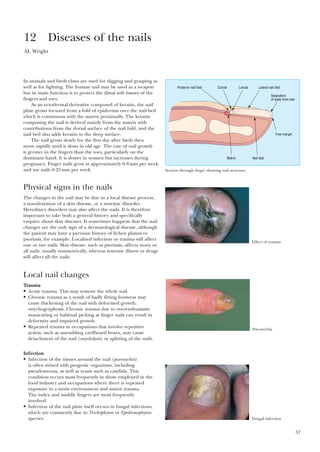 57
In animals and birds claws are used for digging and grasping as
well as for fighting. The human nail may be used as a weapon
but its main function is to protect the distal soft tissues of the
fingers and toes.
As an ectodermal derivative composed of keratin, the nail
plate grows forward from a fold of epidermis over the nail bed
which is continuous with the matrix proximally. The keratin
composing the nail is derived mainly from the matrix with
contributions from the dorsal surface of the nail fold, and the
nail bed also adds keratin to the deep surface.
The nail grows slowly for the first day after birth then
more rapidly until it slows in old age. The rate of nail growth
is greater in the fingers than the toes, particularly on the
dominant hand. It is slower in women but increases during
pregnancy. Finger nails grow at approximately 0·8mm per week
and toe nails 0·25mm per week.
Physical signs in the nails
The changes in the nail may be due to a local disease process,
a manifestation of a skin disease, or a systemic disorder.
Hereditary disorders may also affect the nails. It is therefore
important to take both a general history and specifically
enquire about skin diseases. It sometimes happens that the nail
changes are the only sign of a dermatological disease, although
the patient may have a previous history of lichen planus or
psoriasis, for example. Localised infection or trauma will affect
one or two nails. Skin disease, such as psoriasis, affects many or
all nails, usually symmetrically, whereas systemic illness or drugs
will affect all the nails.
Local nail changes
Trauma
• Acute trauma. This may remove the whole nail.
• Chronic trauma as a result of badly fitting footwear may
cause thickening of the nail with deformed growth,
onychogryphosis. Chronic trauma due to overenthusiastic
manicuring or habitual picking at finger nails can result in
deformity and impaired growth.
• Repeated trauma in occupations that involve repetitive
action, such as assembling cardboard boxes, may cause
detachment of the nail (onycholysis) or splitting of the nails.
Infection
• Infection of the tissues around the nail (paronychia)
is often mixed with pyogenic organisms, including
pseudomonas, as well as yeasts such as candida. This
condition occurs most frequently in those employed in the
food industry and occupations where there is repeated
exposure to a moist environment and minor trauma.
The index and middle fingers are most frequently
involved.
• Infection of the nail plate itself occurs in fungal infections,
which are commonly due to Trichophyton or Epidermophyton
species.
12 Diseases of the nails
AL Wright
Posterior nail fold Lateral nail fold
Separation
of plate from bed
Cuticle Lunula
Matrix Nail bed
Free margin
Section through finger showing nail structure
Effect of trauma
Paronychia
Fungal infection
 