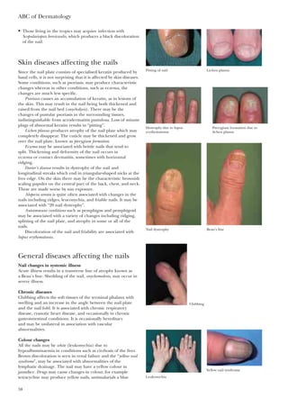 • Those living in the tropics may acquire infection with
Scopulariopsis brevicaulis, which produces a black discoloration
of the nail.
Skin diseases affecting the nails
Since the nail plate consists of specialised keratin produced by
basal cells, it is not surprising that it is affected by skin diseases.
Some conditions, such as psoriasis, may produce characteristic
changes whereas in other conditions, such as eczema, the
changes are much less specific.
Psoriasis causes an accumulation of keratin, as in lesions of
the skin. This may result in the nail being both thickened and
raised from the nail bed (onycholysis). There may be the
changes of pustular psoriasis in the surrounding tissues,
indistinguishable from acrodermatitis pustulosa. Loss of minute
plugs of abnormal keratin results in “pitting”.
Lichen planus produces atrophy of the nail plate which may
completely disappear. The cuticle may be thickened and grow
over the nail plate, known as pterygium formation.
Eczema may be associated with brittle nails that tend to
split. Thickening and deformity of the nail occurs in
eczema or contact dermatitis, sometimes with horizontal
ridging.
Darier’s disease results in dystrophy of the nail and
longitudinal streaks which end in triangular-shaped nicks at the
free edge. On the skin there may be the characteristic brownish
scaling papules on the central part of the back, chest, and neck.
These are made worse by sun exposure.
Alopecia areata is quite often associated with changes in the
nails including ridges, leuconychia, and friable nails. It may be
associated with “20 nail dystrophy”.
Autoimmune conditions such as pemphigus and pemphigoid
may be associated with a variety of changes including ridging,
splitting of the nail plate, and atrophy in some or all of the
nails.
Discoloration of the nail and friability are associated with
lupus erythematosus.
General diseases affecting the nails
Nail changes in systemic illness
Acute illness results in a transverse line of atrophy known as
a Beau’s line. Shedding of the nail, onychomedesis, may occur in
severe illness.
Chronic diseases
Clubbing affects the soft tissues of the terminal phalanx with
swelling and an increase in the angle between the nail plate
and the nail fold. It is associated with chronic respiratory
disease, cyanotic heart disease, and occasionally in chronic
gastrointestinal conditions. It is occasionally hereditary
and may be unilateral in association with vascular
abnormalities.
Colour changes
All the nails may be white (leukonychia) due to
hypoalbuminaemia in conditions such as cirrhosis of the liver.
Brown discoloration is seen in renal failure and the “yellow nail
syndrome”, may be associated with abnormalities of the
lymphatic drainage. The nail may have a yellow colour in
jaundice. Drugs may cause changes in colour, for example
tetracycline may produce yellow nails, antimalarials a blue
ABC of Dermatology
58
Pitting of nail Lichen planus
Dystrophy due to lupus
erythematosus
Pterygium formation due to
lichen planus
Nail dystrophy Beau’s line
Clubbing
Leukonychia
Yellow nail syndrome
 