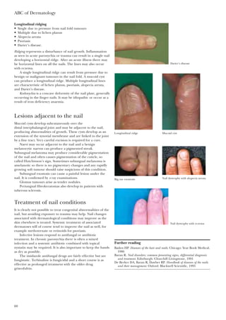 Longitudinal ridging
• Single due to pressure from nail fold tumours
• Multiple due to lichen planus
• Alopecia areata
• Psoriasis
• Darier’s disease.
Ridging represents a disturbance of nail growth. Inflammation
as seen in acute paronychia or trauma can result in a single nail
developing a horizontal ridge. After an acute illness there may
be horizontal lines on all the nails. The lines may also occur
with eczema.
A single longitudinal ridge can result from pressure due to
benign or malignant tumours in the nail fold. A mucoid cyst
can produce a longitudinal ridge. Multiple longitudinal lines
are characteristic of lichen planus, psoriasis, alopecia areata,
and Darier’s disease.
Koilonychia is a concave deformity of the nail plate, generally
occurring in the finger nails. It may be idiopathic or occur as a
result of iron deficiency anaemia.
Lesions adjacent to the nail
Mucoid cysts develop subcutaneously over the
distal interphalangeal joint and may be adjacent to the nail,
producing abnormalities of growth. These cysts develop as an
extension of the synovial membrane and are linked to the joint
by a fine tract. Very careful excision is required for a cure.
Naevi may occur adjacent to the nail and a benign
melanocytic naevus can produce a pigmented streak.
Subungual melanoma may produce considerable pigmentation
of the nail and often causes pigmentation of the cuticle, so
called Hutchinson’s sign. Sometimes subungual melanoma is
amelanotic so there is no pigmentary changes and any rapidly
growing soft tumour should raise suspicions of this condition.
Subungual exostosis can cause a painful lesion under the
nail. It is confirmed by x ray examinations.
Glomus tumours arise as tender nodules.
Periungual fibrokeratomas also develop in patients with
tuberous sclerosis.
Treatment of nail conditions
It is clearly not possible to treat congenital abnormalities of the
nail, but avoiding exposure to trauma may help. Nail changes
associated with dermatological conditions may improve as the
skin elsewhere is treated. Systemic treatment of associated
dermatoses will of course tend to improve the nail as well, for
example methotrexate or retinoids for psoriasis.
Infective lesions respond to antifungal or antibiotic
treatment. In chronic paronychia there is often a mixed
infection and a systemic antibiotic combined with topical
nystatin may be required. It is also important to keep the hands
as dry as possible.
The imidazole antifungal drugs are fairly effective but are
fungistatic. Terbinaline is fungicidal and a short course is as
effective as prolonged treatment with the older drug
griseofulvin.
ABC of Dermatology
60
Further reading
Baden HP. Diseases of the hair and nails. Chicago: Year Book Medical,
1986
Baran R. Nail disorders: common presenting signs, differential diagnosis
and treatment. Edinburgh: Churchill Livingstone, 1991
De Berker DA, Baran R, Dawber RP. Handbook of diseases of the nails
and their management. Oxford: Blackwell Scientific, 1995
Longitudinal ridge Mucoid cyst
Big toe exostosis Nail dystrophy with alopecia areata
Nail dystrophy with eczema
Darier’s disease
 