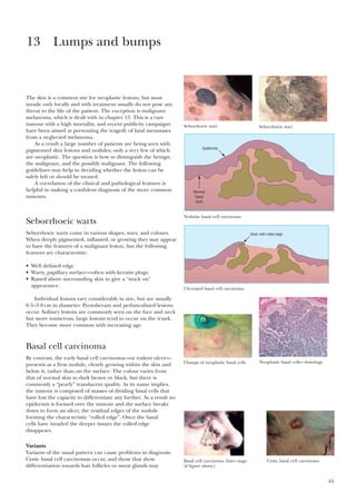 61
The skin is a common site for neoplastic lesions, but most
invade only locally and with treatment usually do not pose any
threat to the life of the patient. The exception is malignant
melanoma, which is dealt with in chapter 15. This is a rare
tumour with a high mortality, and recent publicity campaigns
have been aimed at preventing the tragedy of fatal metastases
from a neglected melanoma.
As a result a large number of patients are being seen with
pigmented skin lesions and nodules, only a very few of which
are neoplastic. The question is how to distinguish the benign,
the malignant, and the possibly malignant. The following
guidelines may help in deciding whether the lesion can be
safely left or should be treated.
A correlation of the clinical and pathological features is
helpful in making a confident diagnosis of the more common
tumours.
Seborrhoeic warts
Seborrhoeic warts come in various shapes, sizes, and colours.
When deeply pigmented, inflamed, or growing they may appear
to have the features of a malignant lesion, but the following
features are characteristic:
• Well defined edge.
• Warty, papillary surface—often with keratin plugs.
• Raised above surrounding skin to give a “stuck on”
appearance.
Individual lesions vary considerably in size, but are usually
0·5–3·0cm in diameter. Protuberant and pedunculated lesions
occur. Solitary lesions are commonly seen on the face and neck
but more numerous, large lesions tend to occur on the trunk.
They become more common with increasing age.
Basal cell carcinoma
By contrast, the early basal cell carcinoma—or rodent ulcer—
presents as a firm nodule, clearly growing within the skin and
below it, rather than on the surface. The colour varies from
that of normal skin to dark brown or black, but there is
commonly a “pearly” translucent quality. As its name implies,
the tumour is composed of masses of dividing basal cells that
have lost the capacity to differentiate any further. As a result no
epidermis is formed over the tumour and the surface breaks
down to form an ulcer, the residual edges of the nodule
forming the characteristic “rolled edge”. Once the basal
cells have invaded the deeper tissues the rolled edge
disappears.
Variants
Variants of the usual pattern can cause problems in diagnosis.
Cystic basal cell carcinomas occur, and those that show
differentiation towards hair follicles or sweat glands may
13 Lumps and bumps
Seborrhoeic wart Seborrhoeic wart
Epidermis
Normal
basal
layer
Nodular basal cell carcinoma
Ulcer with rolled edge
Ulcerated basal cell carcinoma
Neoplastic basal cells—histologyClumps of neoplastic basal cells
Basal cell carcinoma (later stage
of figure above)
Cystic basal cell carcinoma
 