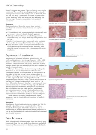 have a less typical appearance. Pigmented lesions can resemble
melanoma. The superficial spreading type may be confused
with a patch of eczema. This usually occurs on the trunk, does
not itch, and shows a gradual but inexorable increase in size.
A firm “whipcord” edge may be present. The sclerosing type
has scarring of the epidermis associated with basal cell
carcinoma.
Treatment
Various methods of destroying tumour tissue are used
and the results are similar for radiotherapy and surgical
excision:
• Ulcerated lesions may invade tissue planes, blood vessels, and
nerves more extensively than is clinically apparent.
• Although modern techniques of radiotherapy result in
minimal scarring and atrophy these may cause problems near
the eye.
• Basal cell carcinomas in skin creases, such as the nasolabial
fold, tend to ulcerate and are hard to excise adequately.
• Surgical excision has the advantage that should the lesion
recur, radiotherapy is available to treat it, whereas it is not
desirable to treat recurrences after radiotherapy with further
irradiation.
Squamous cell carcinoma
Squamous cell carcinoma represents proliferation of the
epidermal keratinocytes in a deranged manner—with a visible
degree of differentiation into epidermal cells that may show
individual cell keratinisation and “pearls” of keratin. In other
tumours bizarre cells with mitoses, cells with clear cytoplasm, or
spindle cells may be seen.
This type of cancer often develops from a preceding solar
keratosis or an area of Bowen’s disease. They may also
complicate a chronic ulcer due to stasis, as in venous ulcer of
the ankle, or infection such as leprosy or tuberculosis. In
addition to local spread, metastases can occur with involvement
of other organs such as the liver, lung or brain, and
lymphadenopathy. The first change clinically is a thickening of
the skin with scaling or hyperkeratosis of the surfaces. The
more differentiated tumours often have a warty, keratotic crust
whereas others may be nodular. The edge is poorly defined.
There may be associated dilated, telangiectatic blood vessels.
The original hard, disc-like lesion becomes nodular and
ulcerates with strands of tumour cells invading the deeper
tissue. The thick warty crust, often found elsewhere, may be
absent from the lesions on the lip, buccal mucosa, and penis.
These histological changes complement the clinical
appearance and are clearly different from those of basal cell
carcinoma.
Treatment
Small lesions should be excised as a rule, making sure that the
palpable edge of the tumour is included, with a 3–5mm
margin. Radiotherapy is effective but fragile scars may be a
disadvantage on the hand. Cryotherapy or topical fluorouracil
can be used for histologically confirmed, superficial lesions and
also for solar keratoses.
Solar keratoses
Solar keratoses occur on sites exposed to the sun and are more
common in those who have worked out of doors or sunbathed
excessively. The common sites are the face, back of the hands,
ABC of Dermatology
62
Superficial basal cell carcinoma Pigmented basal cell carcinoma
Sclerosing basal cell carcinoma
Squamous cell carcinoma—initial
changes
Squamous cell carcinoma—more
differentiated tumour
Ulcer Epidermis
Squamous neoplastic cells
Squamous cell carcinoma—histological
appearance
Solar keratoses
 