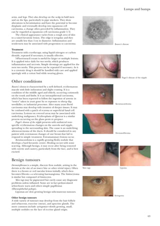 arms, and legs. They also develop on the scalp in bald men
and on the lips, particularly in pipe smokers. They show
alterations in keratinisation and have the potential to become
dysplastic and eventually develop into squamous cell
carcinoma, a change often preceded by inflammation. They
can be regarded as squamous cell carcinoma grade 1/2.
The clinical appearance varies from a rough area of skin
to a raised keratotic lesion. The edge is irregular and they
are usually less than 1cm in diameter. Inflammation and
tenderness may be associated with progression to carcinoma.
Treatment
Treatment with cryotherapy, using liquid nitrogen or carbon
dioxide, repeated if necessary, is usually effective.
5-Fluorouracil cream is useful for larger or multiple lesions.
It is applied twice daily for two weeks, which produces
inflammation and necrosis. Simple dressings are applied for the
next two weeks. This process can be repeated if necessary. As it
is a cytotoxic drug it should be handled with care and applied
sparingly with a cotton bud while wearing gloves.
Other conditions
Bowen’s disease is characterised by a well defined, erythematous
macule with little induration and slight crusting. It is a
condition of the middle aged and elderly, occurring commonly
on the trunk and limbs. It is an intraepidermal carcinoma,
which has been reported to follow the ingestion of arsenic in
“tonics” taken in years gone by or exposure to sheep dip,
weedkiller, or industrial processes. After many years florid
carcinoma may develop with invasion of deeper tissues. It may
be confused with a patch of eczema or superficial basal cell
carcinoma. Lesions on covered areas may be associated with
underlying malignancy. Erythroplasia of Queyrat is a similar
process occurring on the glans penis or prepuce.
Paget’s disease of the nipple presents with unilateral non-
specific erythematous changes on the aureola and nipple,
spreading to the surrounding skin. The cause is an underlying
adenocarcinoma of the ducts. It should be considered in any
patient with eczematous changes of one breast that fail to
respond to simple treatment. Extramammary lesions occur.
Keratoacanthoma is a rapidly growing fleshy nodule that
develops a hard keratotic centre. Healing occurs with some
scarring. Although benign, it may recur after being removed
with curette and cautery, particularly from the face, and is best
excised.
Benign tumours
Dermatofibroma is a simple, discrete firm nodule, arising in the
dermis at the site of an insect bite or other trivial injury. Often
there is a brown or red vascular lesion initially, which then
becomes fibrotic—a sclerosing haemangioma. The histiocytoma
is similar but composed of histiocytes.
Skin tags may be pigmented but rarely cause any diagnostic
problems unless inflamed. Some are in fact pedunculated
seborrhoeic warts and others simple papillomas
(fibroepithelial polyps).
Lipomas are slow growing benign subcutaneous tumours.
Other benign tumours
A wide variety of tumours may develop from the hair follicle
and sebaceous, exocrine (sweat), and apocrine glands. The
more common include syringomas—slowly growing, small,
multiple nodules on the face of eccrine gland origin.
Lumps and bumps
63
Bowen’s disease
Paget’s disease of the nipple
Keratoacanthoma
Dermatofibroma
Skin tags
Syringoma
Lipoma
 