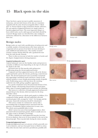 68
There has been a great increase in public awareness of
melanoma, and any dark lesions of the skin are sometimes
regarded with the same dread as Long John Silver’s “black
spot” in Treasure Island—a sign of imminent demise. However,
the vast majority of pigmented lesions are simply moles or
harmless pigmented naevi. The most important thing is to
know which moles can be safely ignored and which should be
removed. Benign moles are described first, then malignant
melanoma, followed by a discussion of the differences between
these two.
Benign moles
Benign moles are naevi with a proliferation of melanocytes and
a variable number of dermal naevus cells. Some moles are
congenital and are present from birth, but most develop in
early childhood and adolescence. The number of moles
remains constant during adult life with a gradual decrease
from the sixth decade onwards.
There is often an increase in both the number of moles and
the degree of pigmentation during pregnancy.
Acquired melanocytic naevi
Acquired melanocytic naevi are the familiar moles and present in
a number of different ways depending on the type of cells and
the depth in the skin.
Junctional naevi are flat macules with melanocytes
proliferating along the dermo-epidermal border.
Compound naevi have pigmented naevus cells at the dermo-
epidermal border and in the dermis, producing a raised brown
lesion. The dermal melanocytes may accumulate around the
skin appendages and blood vessels and form a band of cells
without melanin or more deeply penetrating strands of spindle
cells. Proliferating naevus cells may throw the overlying
epidermis into folds, giving a papillary appearance.
In a purely intradermal naevus the junctional element is lost,
with the deeper cells showing characteristics of neural tissue.
Other types of acquired pigmented naevi include the following.
Blue naevus is a collection of deeply pigmented melanocytes
situated deep in the dermis, which accounts for the deep
slate-blue colour.
Spitz naevus presents as a fleshy pink papule in children. It is
composed of large spindle cells and epitheloid cells with
occasional giant cells, arranged in “nests”. It is benign and the
old name of juvenile melanoma should be abandoned.
Halo naevus consists of a melanocytic naevus with a
surrounding halo of depigmentation associated with the
presence of antibodies against melanocytes in some cases.
The whole naevus gradually fades in time.
Becker’s naevus is an area of increased pigmentation, often
associated with increased hair growth, which is usually seen on
the upper trunk or shoulders. It is benign.
Freckles or ephelides are small pigmented macules, less than
0·5cm in diameter, that occur in areas exposed to the sun in fair
skinned people. These macules fade during the winter months.
Congenital pigmented naevi
Congenital pigmented naevi are present at birth, generally over
1cm in diameter, and vary from pale brown to black in colour.
They often become hairy and more protuberant, possibly with
15 Black spots in the skin
Benign moles
Benign mole
Benign pigmented naevus
Blue naevus
Spitz naevus
Halo naevus
Becker’s naevus
 