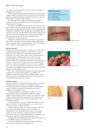 ABC of Dermatology
74
the mouth and on the fingers. There are also flat “mat-like”
telangiectasia on the face.
Workers manufacturing polyvinyl chloride can develop skin
changes similar to systemic sclerosis with erosions of the bones,
hepatic and pulmonary lesions. Pesticides and epoxy resin can
also produce scleroderma-like changes.
It is associated with antinuclear antibodies (speckled or
nucleolar), and in about 50% of cases, circulating immune
complexes may be present.
A variant is the CREST syndrome. In this type of scleroderma
there is Calcinosis with calcium deposits below the skin on the
fingers and toes, Raynaud’s phenomenon with poor peripheral
circulation, immobility of the oEsophagus, dermal Sclerosis of
the fingers and toes, and Telangiectasia of the face and lips and
adjacent to the toe and finger nails. It has a better prognosis
than systemic sclerosis. Antinuclear antibodies at the
centromere are frequently present.
Morphoea is a benign form of localised systemic sclerosis in
which there is localised sclerosis with very slight inflammation.
There is atrophy of the overlying epidermis. The early changes
often consist of a dusky appearance to the skin.
Lichen sclerosus
The full name is lichen sclerosis et atrophicus—or LSA. This is
a relatively uncommon condition seen mainly in women in
whom well defined patches of superficial atrophy of the
epidermis occur with a white colour. There is fibrosis of the
underlying tissues. It frequently occurs in the vulva and
perineum and may also appear on the penis as balanitis
xerotica obliterans. Extragenital lesions may occur anywhere on
the skin. It may occur in a more acute form in children where
it tends to resolve, but in adults it is a very chronic condition.
There is an increased incidence of squamous cell carcinoma.
Treatment is with topical steroids and excision of any areas that
appear to be developing tumours.
The cause of the hyalinized collagen and epidermal atrophy
is unknown, but in early lesions there is an infiltrate of
lymphocytes with CD3, CD4, CD8, and CD68 markers. There is
also an increase in Langerhans cells, so there may well be an
immunological basis for these changes.
Vascular changes
Vascular lesions are associated with a wide range of conditions
including infections, neoplasia, and allergic reactions.
Hormones, particularly oestrogen, may affect the small blood
vessels of the skin to produce telangiectasia and small
angiomas, such as spider naevi.
Vasculitis and purpura, described in chapter 7, may be
associated with disease of the kidneys and other organs.
“Splinter haemorrhages” under the nails are usually the result
of minor trauma but may be associated with a wide range of
conditions, including subacute bacterial endocarditis and
rheumatoid arthritis.
Livedo reticularis is a cyanotic, net-like discoloration of the
skin over the legs. It may be idiopathic or associated with
arteritis or changes in blood viscosity.
Erythrocyanosis is a dusky, red, cyanotic change in the skin
over the legs and thighs, where there is a deep layer of
underlying fat. The condition becomes worse in the winter
months. It is most common in young women and usually
resolves over the years. Lupus erythematosus, sarcoidosis, and
tuberculous infection may localise in affected areas.
Telangiectasia and clubbing may be features of scleroderma
in the CREST syndrome described above.
In carcinoid and phaeochromocytoma vasoactive substances
cause episodes of flushing and telangiectasia.
CREST syndrome
• C—Calcinosis cutis
• R—Raynaud’s phenomenon
• E—Esophagus
• S—Scleroderma
• T—Telangiectasia
Calcinosis cutis
CREST syndrome
Vasculitis
Livedo reticulosis
 