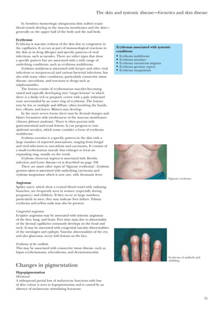 The skin and systemic disease—Genetics and skin disease
75
In hereditary haemorrhagic telangiectasia thin walled ectatic
blood vessels develop in the mucous membranes and the skin—
generally on the upper half of the body and the nail beds.
Erythemas
Erythema is macular redness of the skin due to congestion in
the capillaries. It occurs as part of immunological reactions in
the skin as in drug allergies and specific patterns of viral
infections, such as measles. There are other types that show
a specific pattern but are associated with a wide range of
underlying conditions, such as erythema multiforme.
Erythema multiforme is associated with herpes and other viral
infections or streptococcal and various bacterial infections, but
also with many other conditions, particularly connective tissue
disease, sarcoidosis, and reactions to drugs such as
sulphonamides.
The lesions consist of erythematous macules becoming
raised and typically developing into “target lesions” in which
there is a dusky red or purpuric centre with a pale indurated
zone surrounded by an outer ring of erythema. The lesions
may be few or multiple and diffuse, often involving the hands,
feet, elbows, and knees. Blisters may develop.
In the more severe forms there may be dermal changes and
blister formation with involvement of the mucous membranes
(Stevens–Johnson syndrome). There is often pyrexia with
gastrointestinal and renal lesions. It can progress to toxic
epidermal necrolysis, which some consider a form of erythema
multiforme.
Erythema annulare is a specific pattern in the skin with a
large number of reported associations, ranging from fungal
and viral infections to sarcoidosis and carcinoma. It consists of
a small erythematous macule that enlarges to form an
expanding ring, usually on the trunk.
Erythema chronicum migrans is associated with Borrelia
infection and Lyme disease—it is described on page 106.
There are many other types of “figurate erythemas”. Erythema
gyratum repens is associated with underlying carcinoma and
erythema marginatum, which is now rare, with rheumatic fever.
Angiomas
Spider naevi, which show a central blood vessel with radiating
branches, are frequently seen in women (especially during
pregnancy) and children. If they occur in large numbers,
particularly in men, they may indicate liver failure. Palmar
erythema and yellow nails may also be present.
Congenital angiomas
Eruptive angiomas may be associated with systemic angiomas
of the liver, lung, and brain. Port wine stain due to abnormality
of the dermal capillaries commonly develops on the head and
neck. It may be associated with congenital vascular abnormalities
of the meningies and epilepsy. Vascular abnormalities of the eye,
and also glaucoma, occur with lesions on the face.
Erythema of the nailbeds
This may be associated with connective tissue disease, such as
lupus erythematosus, scleroderma, and dermatomyositis.
Changes in pigmentation
Hypopigmentation
Hormonal
A widespread partial loss of melanocyte functions with loss
of skin colour is seen in hypopituitarism and is caused by an
absence of melanocyte stimulating hormone.
Erythemas associated with systemic
conditions
• Erythema multiforme
• Erythema annulare
• Erythema chronicum migrans
• Erythema gyratum repens
• Erythema marginatum
Figurate erythema
Erythema of nailbeds and
clubbing
 