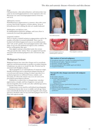 The skin and systemic disease—Genetics and skin disease
77
Drugs
Chlorpromazine, other phenothiazines, and minocycline may
cause an increased pigmentation in areas exposed to the sun.
Phenytoin can cause local hyperpigmentation of the face
and neck.
Inflammatory reactions
Postinflammatory pigmentation is common, often after acute
eczema, fixed drug eruptions, or lichen planus. Areas of
lichenification from rubbing the skin are usually darkened.
Malabsorption and deficiency states
In malabsorption syndromes, pellagra, and scurvy there is
commonly increased skin pigmentation.
Congenital conditions
There is clearly a marked variation in pigmentation and in the
number of freckles in normal individuals. There may be
localised well defined pigmented areas in neurofibromatosis
with “cafe au lait” patches. Increased pigmentation with a blue
tinge occurs over the lumbosacral region in the condition
known as Mongolian blue spot.
Peutz–Jeghers syndrome is described under the section
“The gut and the skin”, below. There are pigmented macules
associated with intestinal polyposis in the oral mucosa, lips,
and face.
Malignant lesions
Malignant lesions may cause skin changes such as acanthosis
nigricans and dermatomyositis or produce secondary deposits.
Lymphomas can arise in or invade the skin. Pruritus may be
associated with Hodgkin’s disease.
Mycosis fungoides is a T cell lymphoma of cutaneous origin.
Initially well demarcated erythematous plaques develop on
covered areas with intense itching. In many cases there is a
gradual progression to infiltrated lesions, nodules, and
ulceration. In others the tumour may occur de novo or be
preceded by generalised erythema.
Poikiloderma, in which there is telangiectasia, reticulate
pigmentation, atrophy, and loss of pigment, may precede
mycosis fungoides, but it is also seen after radiotherapy and in
connective tissue diseases.
Parapsoriasisis a term used for well defined maculopapular
erythematous lesions that occur in middle and old age. Some
cases undoubtedly develop into mycosis fungoides and a biopsy
specimen should be taken of any such fixed plaques that do not
clear with topical steroids.
Skin markers of internal malignancy
• Acanthosis nigricans—usually intra-abdominal lesions
• Erythematous rashes, “figurate erythema”
• Pruritus—usually lymphoma
• Dermatomyositis in the middle aged and elderly
• Acquired ichthyosis
Non-specific skin changes associated with malignant
disease
• Secondary deposits
• Secondary hormonal effects
Acne (adrenal tumours)
Flushing (carcinoid)
Pigmentation
• Generalised pruritus (particularly lymphoma)
• Figurate erythema
• Superficial thrombophlebitis
• Various eruptive skin lesions seen in Gardener’s and Bazex
syndromes
Neurofibromatosis Neurofibromatosis
Increased pigmentation in
malabsorption syndrome
Peutz–Jeghers syndrome
B cell lymphoma
Lymphoma
Poikiloderma
Parapsoriasis
 