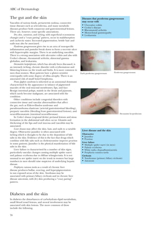 ABC of Dermatology
78
The gut and the skin
Vasculitis of various kinds, periarteritis nodosa, connective
tissue diseases such as scleroderma, and many metabolic
diseases produce both cutaneous and gastrointestinal lesions.
There are, however, some specific associations.
Dry skin, asteatosis, and itching, with superficial eczematous
changes and a “crazy paving” pattern, occur in malabsorption
and cachectic states. Increased pigmentation, brittle hair and
nails may also be associated.
Pyoderma gangrenosum gives rise to an area of non-specific
inflammation and pustules break down to form a necrotic ulcer
with hypertrophic margins. There is an underlying vasculitis.
There is a strong association with ulcerative colitis and also with
Crohn’s disease, rheumatoid arthritis, abnormal gamma
globulins, and leukaemia.
Dermatitis herpetiformis, which has already been discussed, is
an intensely itching, chronic disorder with erythematous and
blistering lesions on the trunk and limbs. It is more common in
men than women. Most patients have a gluten sensitive
enteropathy with some degree of villus atrophy. There is an
associated risk of small bowel lymphoma.
Peutz–Jeghers syndrome is inherited as an autosomal dominant
characterised by the appearance in infancy of pigmented
macules of the oral mucosal membranes, lips, and face.
Benign intestinal polyps, mainly in the ileum and jejunum,
which rarely become malignant, are associated with the
condition.
Other conditions include congenital disorders with
connective tissue and vascular abnormalities that affect
the gut, such as Ehlers–Danlos syndrome and
pseudoxanthoma elasticum (arterial gastrointestinal bleeding),
purpuric vasculitis (bleeding from gastrointestinal lesions), and
neurofibromatosis (intestinal neurofibromas).
In Crohn’s disease (regional ileitis) perianal lesions and sinus
formation in the abdominal wall often occur. Glossitis and
thickening of the lips and oral mucosa and vasculitis may be
associated.
Liver disease may affect the skin, hair, and nails to a variable
degree. Obstructive jaundice is often associated with
itching which is thought to be due to the deposition of bile
salts in the skin. Evidence of this is the fact that drugs which
combine with bile salts such as cholestyramine improve pruritus
in some patients. Jaundice is the physical manifestation of bile
salts in the skin.
Liver failure is characterised by a number of skin signs,
particularly vascular changes causing multiple spider naevi
and palmar erythema due to diffuse telangiectasia. It is not
unusual to see spider naevi on the trunk in women but large
numbers in men should raise suspicion of underlying hepatic
disease.
Porphyria cutanea tarda as a result of chronic liver
disease produces bullae, scarring, and hyperpigmentation
in sun exposed areas of the skin. Xanthomas may be
associated with primary biliary cirrhosis and in chronic liver
disease asteotosis, with dry skin producing a “crazy paving”
pattern.
Diabetes and the skin
In diabetes the disturbances of carbohydrate–lipid metabolism,
small blood vessel lesions, and neural involvement may be
associated with skin lesions. The more common of these
include the following.
Liver disease and the skin
Obstructive
• Jaundice
• Pruritus
Liver failure
• Multiple spider naevi (in men)
• Palmar erythema
• White nails—hypoalbuminaemia
• Porphyria cutanea tarda
Cirrhosis
• Xanthomas (primary biliary cirrhosis)
• Asteatosis
Diseases that pyoderma gangrenosum
may occur with
• Ulcerative colitis
• Crohn’s disease
• Rheumatoid arthritis
• Monoclonal gammopathy
• Leukaemia
Early pyoderma gangrenosum Pyoderma gangrenosum
Dermatitis herpetiformis
 