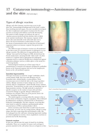 82
Types of allergic reaction
Allergic and other immune reactions may occur in the
skin—the “immunological battleground of the body”—rather
than involving internal organs. An acute vasculitis occurring in
the skin is unpleasant and requires treatment but the same
reaction occurring in the kidneys can be life threatening.
The pattern of skin changes can indicate the type of
immune process involved and also whether there is likely
to be systemic involvement. The immune response of the
skin is also used clinically in the tuberculin skin test to
detect the level of immunity to tuberculosis. It is also
the means of immunisation when an injection of inactivated
organisms induces an immune response that protects the
entire body.
The different types of immune reaction are all manifested
in the skin as part of a normal response to pathogens or as an
allergic reaction. The difference is expressed by the word
“allergy”, first used by Von Pirquet in 1906, derived from the
Greek (␣␥␱␰ ⑀␯␥␱␯), meaning literally “other work”. In other
words it is a response that is appropriate for pathogenic
organisms such as a tubercle bacillus but is misdirected against
a harmless substance such as a rubber glove or the metal of a
watch strap buckle.
Immunological reactions are of four types—five if
autoimmunity is counted—of responses mediated by antibodies
known as the humoral response and one by the lymphocytes
known as the cell mediated response.
Immediate hypersensitivity
This type of reaction is caused by “reagin” antibodies, which
consist mainly of lgE, that react with allergens such as
housedust mite, animal dander, or grass pollens. These
reactions may occur in both the skin or the lung to produce
asthma. Allergic reactions to insect stings can cause severe
systemic effects—“anaphylaxis”, which literally means “without
protection”. Food proteins can also cause an immediate type of
hypersensitivity reaction. The IgE molecule is attached to
specific receptors on the surface of mast cells and when
activated by linkage to specific allergen inflammatory
mediators are released. This is an acute process, hence the
name “immediate hypersensitivity”.
The initial response occurring within five minutes is due to
by the release of histamine, heparin, tryptophan. This is followed
by inflammatory mediators—released in five to 30 minutes—
leukotrien, prostaglandin. The later response, occurring after
some hours, is caused by cytokines—predominantly tumour
necrosis factor ␣ (TNF-␣) and interleukin 4 (IL4).
Severe reactions cause shock that is made worse by stress
and exercise, as in the case of a young woman, allergic to wasp
stings, who had a wasp sting when picnicking by a lake. She
then plunged into the cold water, swimming vigorously, leading
to a fatal anaphylactic reaction. Acute anaphylactic reactions to
peanuts may be life threatening.
Cytotoxic reactions
In this case cells become the target of attack by circulating
antibodies. There are a number of causes, such as drugs or
proteins attached to the cell surface that act as haptens so they
17 Cutaneous immunology—Autoimmune disease
and the skin (DJ Gawkrodger)
Reaction to fish protein
Fc receptor
Mast cell Histamine
+ inflammatory
mediators
Ig E
Type I—immediate hypersensitivity
Antibody
Antigen
K cell
+
Complement
Lysis Fc receptor
Target cell
Type II—cytotoxic
 