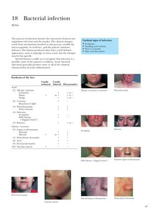 87
The process of infection involves the interaction between two
organisms—the host and the invader. The clinical changes
result from mechanisms involved in this process, notably the
micro-organism, its virulence, and the patient’s immune
defenses. The lesions produced often have a well defined
appearance, such as impetigo or tinea cruris, but the changes
may be less specific.
Several features enable us to recognise that infection is a
possible cause of the patient’s condition. Acute bacterial
infections generally produce some or all of the classical
characteristics of acute inflammation.
18 Bacterial infection
RJ Hay
Cardinal signs of infection
• Erythema
• Swelling and oedema
• Heat or warmth
• Pain and discomfort
Erythema of the face
Usually Usually
unilateral bilateral Photosensitive
Acute
(1) Allergic reactions
Cosmetics ϩ ϩ or Ϫ
Plants ϩ or ϩ ϩ or Ϫ
Drugs ϩ ϩ or Ϫ
(2) Urticaria ϩ Ϫ
Reactions to light
(3) Photodermatitis ϩ ϩ
Solar urticaria ϩ ϩ
(4) Infection
Erysipelas ϩ Ϫ
Fifth disease ϩ Ϫ
(“slapped cheek”)
(5) Rosacea ϩ ϩ or Ϫ
Chronic—recurrent
(6) Lupus erythematosus
Systemic ϩ ϩ
Discoid ϩ or ϩ ϩ
(7) Seborrhoeic dermatitis ϩ Ϫ
(8) Acne ϩ ϩ
(9) Perioral dermatitis ϩ Ϫ
(10) Vascular naevus ϩ Ϫ Ϫ
Allergic reactions to cosmetics Photodermatitis
Erysipelas
Rosacea
Fifth disease (“slapped cheek”)
Systemic lupus erythematosus
Discoid lupus erythematosus Seborrhoeic dermatitis
Perioral dermatitis
Vascular naevus
 