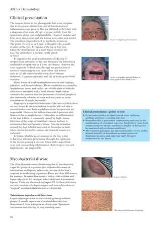 ABC of Dermatology
88
Clinical presentation
The woman shown in the photographs had acute erysipelas
due to streptococcal infection, and all four features of
inflammation were present. She was referred to the clinic with
a diagnosis of an acute allergic response, which, from the
appearance alone, was understandable. However, malaise and
fever were also present and the lesions were warm and tender.
The condition responded well to antibiotic treatment.
The point of entry in such cases is thought to be a small
erosion on the face. Erysipelas of the leg or foot may
follow the development of a small fissure between the
toes, but often there is no discernible portal
of entry.
Erysipelas is the local manifestation of a Group A
streptococcal infection, in the case illustrated the infection is
confined to deep dermis as a form of cellulitis. However the
same organism at distal sites, through the production of
toxins or superantigens, can cause other skin lesions
such as: (a) the rash of scarlet fever; (b) erythema
nodosum; (c) guttate psoriasis; and (d) an acute generalised
vasculitis.
Other forms of local bacterial infection include impetigo,
folliculitis, and furuncles (boils). These conditions are caused by
Staphylococcus aureus and in the case of folliculitis or boils the
infection is associated with a local abscess. Staph. aureus
colonises the anterior nares or perineum of normal people; it
also commonly colonises eczema and may cause an acute
exacerbation of atopic dermatitis.
Impetigo is a superficial infection of the skin of which there
are two forms. In the non-bullous form the affected skin is
covered with crusts. Both staphylococci and streptococci are
responsible. However the bullous form which presents with
blisters is due to staphylococci. Folliculitis, an inflammation
of the hair follicle, is commonly caused by Staph. aureus.
Infection of the scalp or beard hair (sycosis barbae) is
uncommon but may become chronic. Abscess formation
around the hair follicles may result in furuncles or boils;
where several furuncles coalesce the lesion is known as a
carbuncle.
Ecthyma, which is most common on the leg, is due
to bacterial infection penetrating through the epidermis
to the dermis causing a necrotic lesion with a superficial
crust and surrounding inflammation. Both streptococci and
staphylococci are responsible.
Mycobacterial disease
The clinical presentation of infections due to mycobacteria,
a specific group of organisms that includes the causes of
tuberculosis and leprosy, reflects the success of the host’s
response in eradicating organisms. There are clear differences,
for instance, between disseminated miliary tuberculosis and
lupus vulgaris or, for example, tuberculoid and lepromatous
leprosy. These are discussed in chapter 23. As these infections
are not common only lupus vulgaris and non-tuberculous or
“atypical” mycobacterial infection are described.
Tuberculous mycobacterial infections
Lupus vulgaris presents as a very slowly growing indolent
plaque. It usually represents a localised skin infection
disseminated from a deep focus of infection. Squamous
carcinomas may develop in long standing cases.
Clinical presentation—points to note
• In any patient with a localised area of acute erythema,
swelling, and fever—consider infection
• Remember that a generalised erythematous rash may be the
manifestation of a localised infection. Scarlet fever arises from
streptococcal sore throat, and herpes simplex of the lip may
be associated with erythema multiforme
• The common pathogens are also commensals—recent studies
showed that 69% of individuals are nasal carriers of
Staphylococcus aureus and some may carry Group A
streptococci in the throat
Acute erysipelas: presentation
Acute erysipelas: patient shown in
same patient two weeks later
Lupus vulgaris
Mycobacterial disease—histology
 