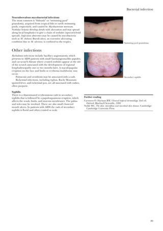 Bacterial infection
89
Non-tuberculous mycobacterial infections
The most common is “fishtank” or “swimming pool”
granuloma, acquired from tropical fish or rarely swimming
pools, respectively, and caused by Mycobacterium marinum.
Nodular lesions develop slowly with ulceration and may spread
along local lymphatics to give a chain of nodules (sporotrichoid
spread). Injection abscesses may be caused by mycobacteria
such as M. chelonei. Buruli ulcer, an extensive ulcerating
condition due to M. ulcerans, is confined to the tropics.
Other infections
Rochalimea infections include bacillary angiomatosis, which
presents in AIDS patients with small haemangioma-like papules,
and cat scratch disease where crusted nodules appear at the site
of the scratch associated with the development of regional
lymphadenopathy one or two months later. A maculopapular
eruption on the face and limbs or erythema multiforme may
occur.
Psittacosis and ornithosis may be associated with a rash.
Rickettsial infections, including typhus, Rocky Mountain
spotted fever, and rickettsial pox, are all associated with rashes,
often purpuric.
Syphilis
There is a disseminated erythematous rash in secondary
syphilis that is followed by a papulosquamous eruption, which
affects the trunk, limbs, and mucous membranes. The palms
and soles may be involved. There are also small clustered
mouth ulcers. In patients with AIDS the rash of secondary
syphilis is florid and often crusted or scaly.
Further reading
Carnwres O, Harman RM. Clinical tropical dermatology. 2nd ed.
Oxford: Blackwell Scientific, 1992
Noble WC. The skin: microflora and microbial skin disease. Cambridge:
Cambridge University Press
Swimming pool granuloma
Secondary syphilis
 