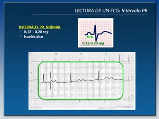 Seg Normal Definition electrocardiograma uwusadasdasdasdasdasdasdas | PPTX