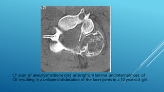 Comprehensive Overview of Aneurysmal Bone Cyst: Diagnosis and Imaging ...