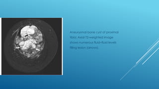 Comprehensive Overview of Aneurysmal Bone Cyst: Diagnosis and Imaging ...