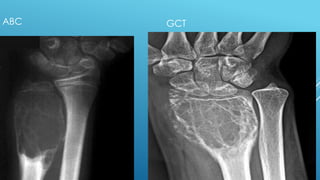 Comprehensive Overview of Aneurysmal Bone Cyst: Diagnosis and Imaging ...