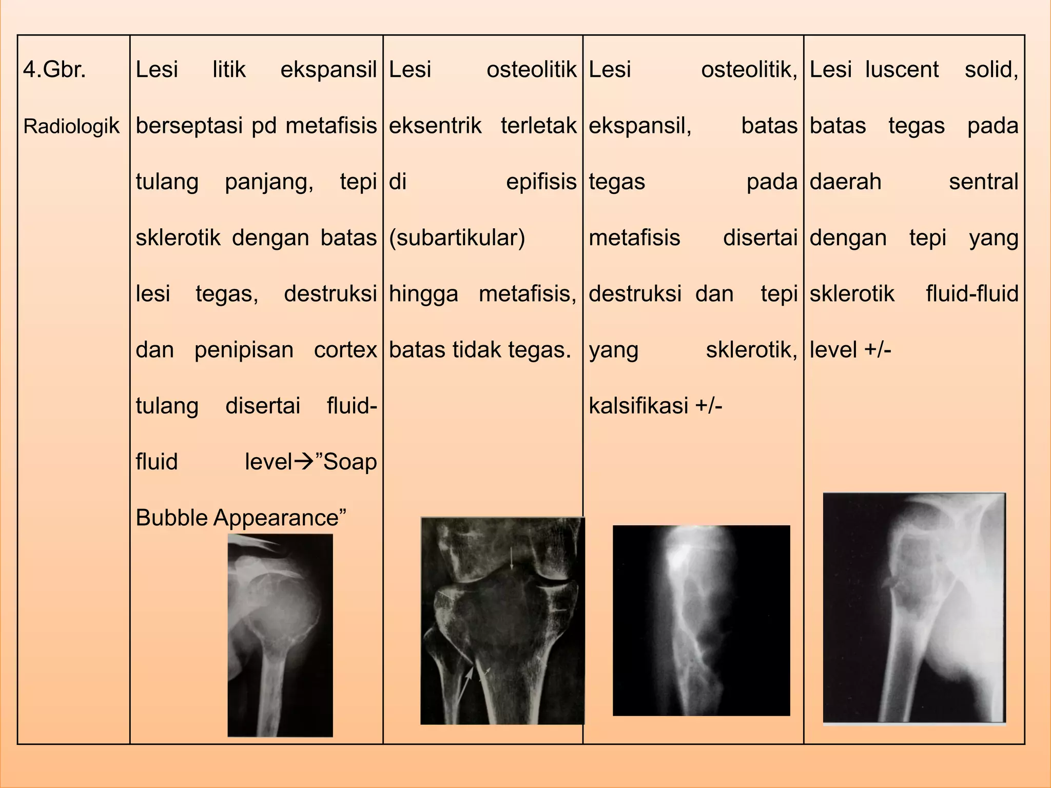 ABC (Aneurysmal Bone Cyst) - Rahmayanti Arief (PP).pdf