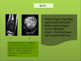 ABC (Aneurysmal Bone Cyst) - Rahmayanti Arief (PP).pdf