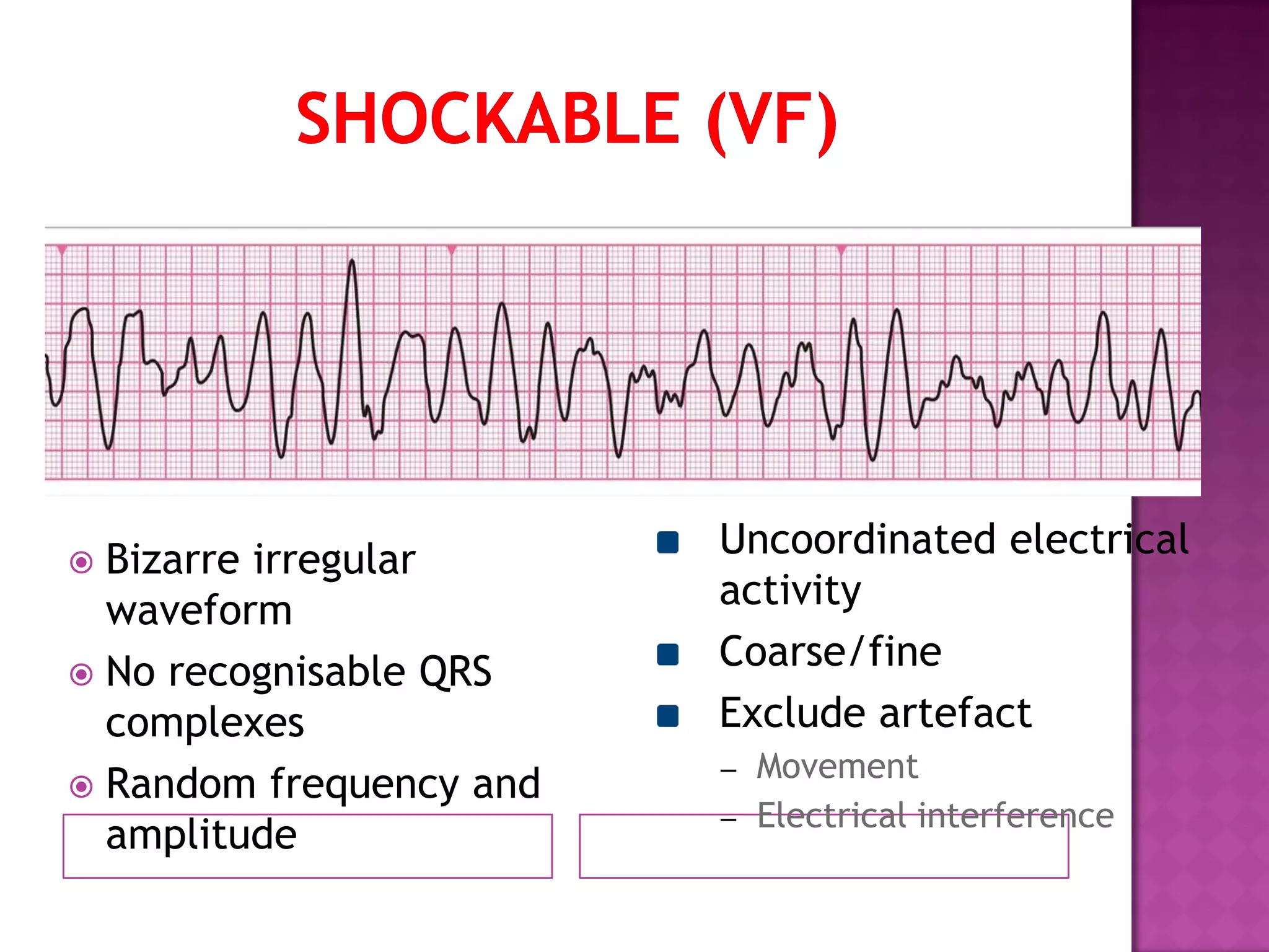  Bizarre irregular
waveform
 No recognisable QRS
complexes
 Random frequency and
amplitude
Uncoordinated electrical
activity
Coarse/fine
Exclude artefact
– Movement
– Electrical interference
 