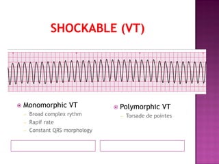  Monomorphic VT
– Broad complex rythm
– Rapif rate
– Constant QRS morphology
 Polymorphic VT
– Torsade de pointes
 